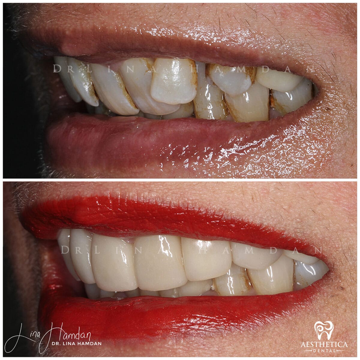 Considered porcelain veneers: anonymous case 84 from Aesthetica Dental Naperville