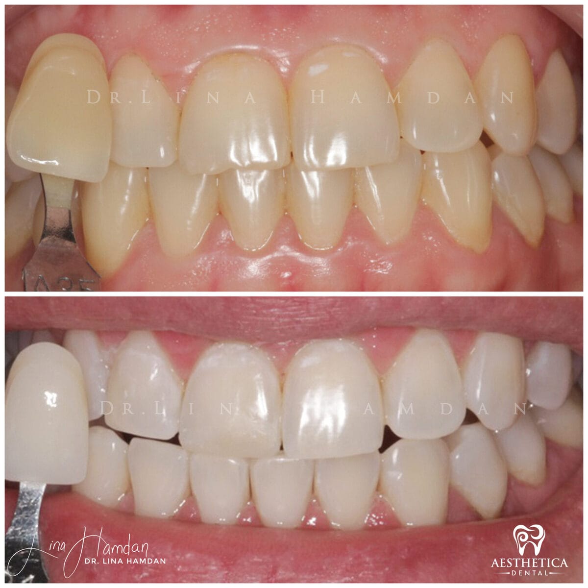 Teeth whitening: anonymous case 2 from Aesthetica Dental Naperville
