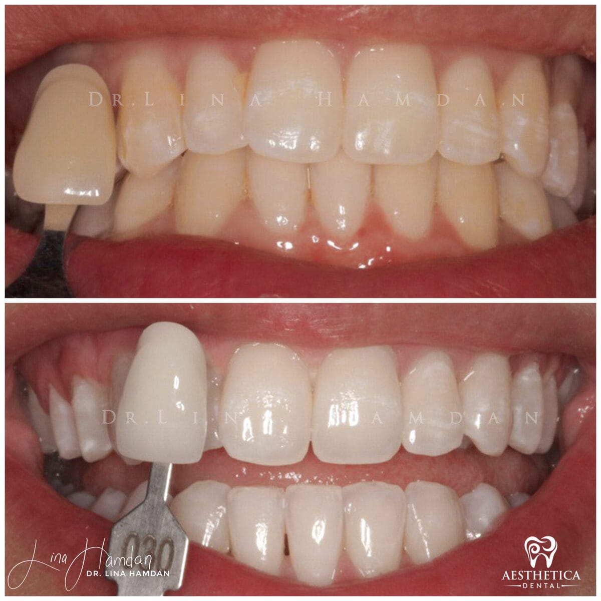 Teeth whitening: anonymous case 3 from Aesthetica Dental Naperville