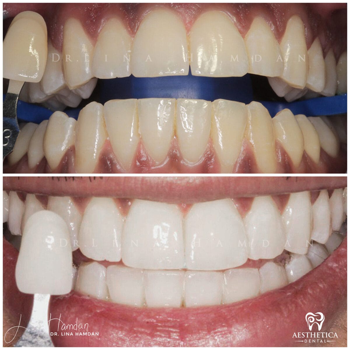Teeth whitening: anonymous case 7 from Aesthetica Dental Naperville