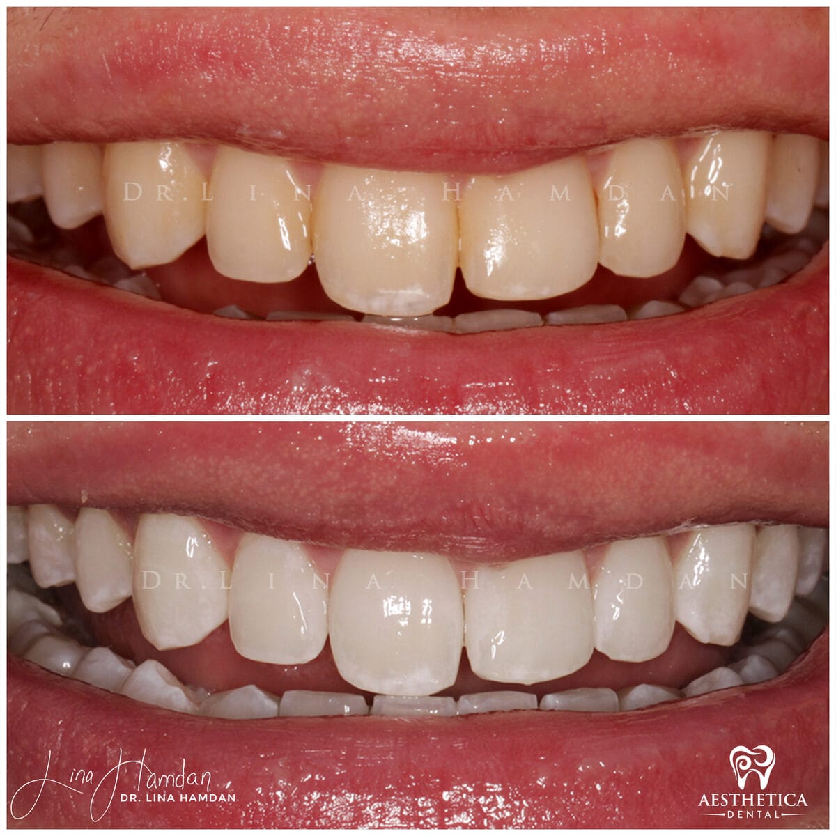 Teeth whitening: anonymous case 8 from Aesthetica Dental Naperville