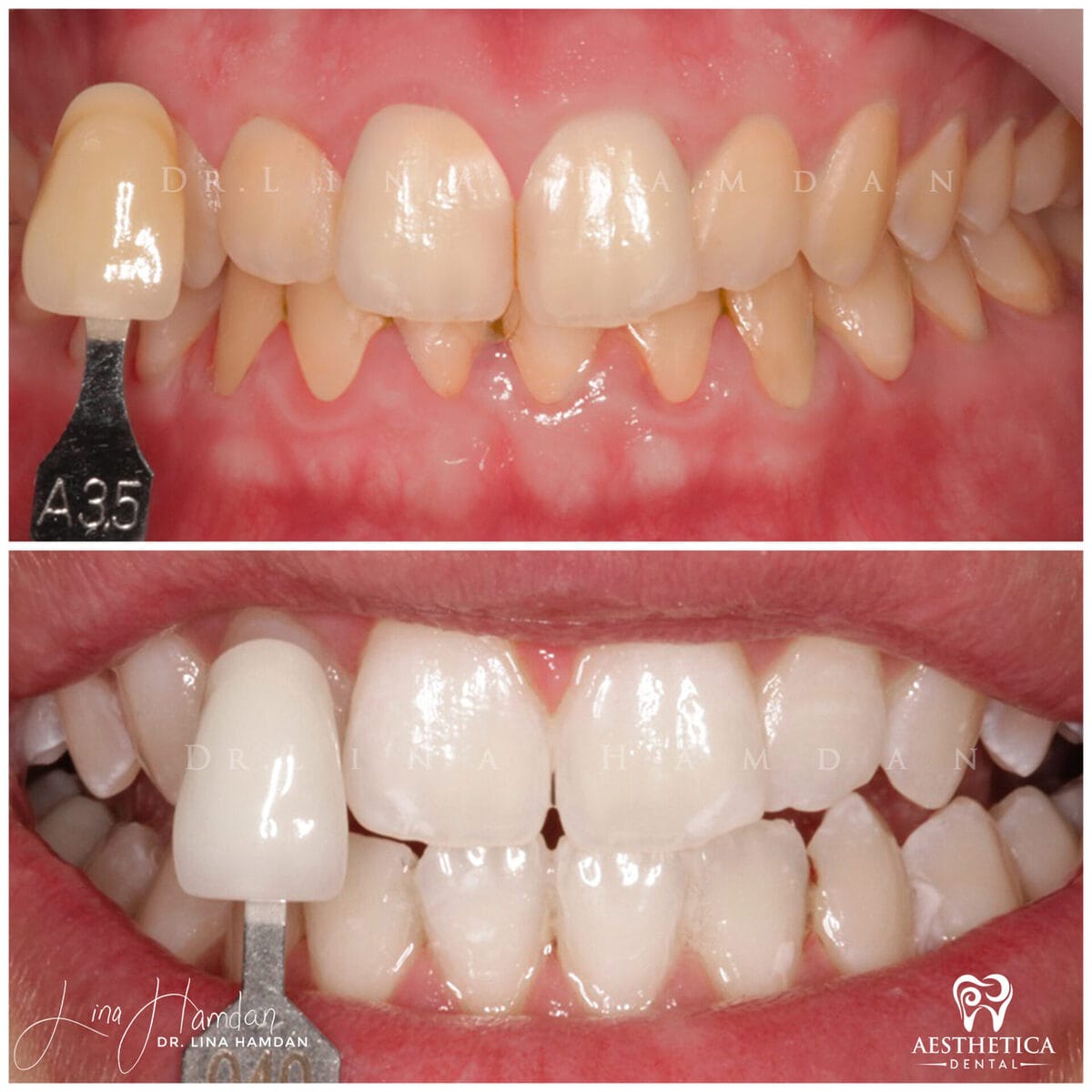 Teeth whitening: anonymous case 9 from Aesthetica Dental Naperville