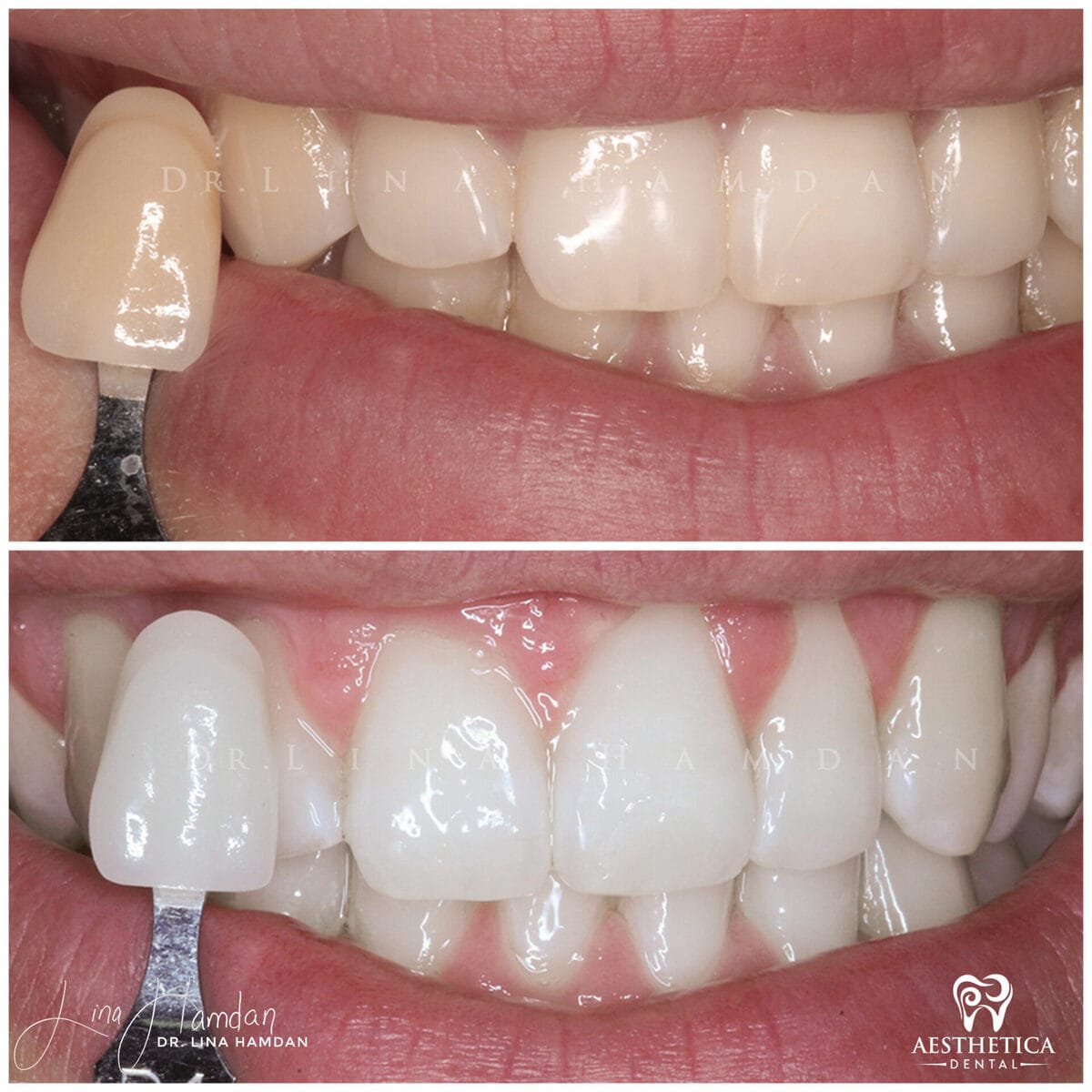 Teeth whitening: anonymous case 13 from Aesthetica Dental Naperville