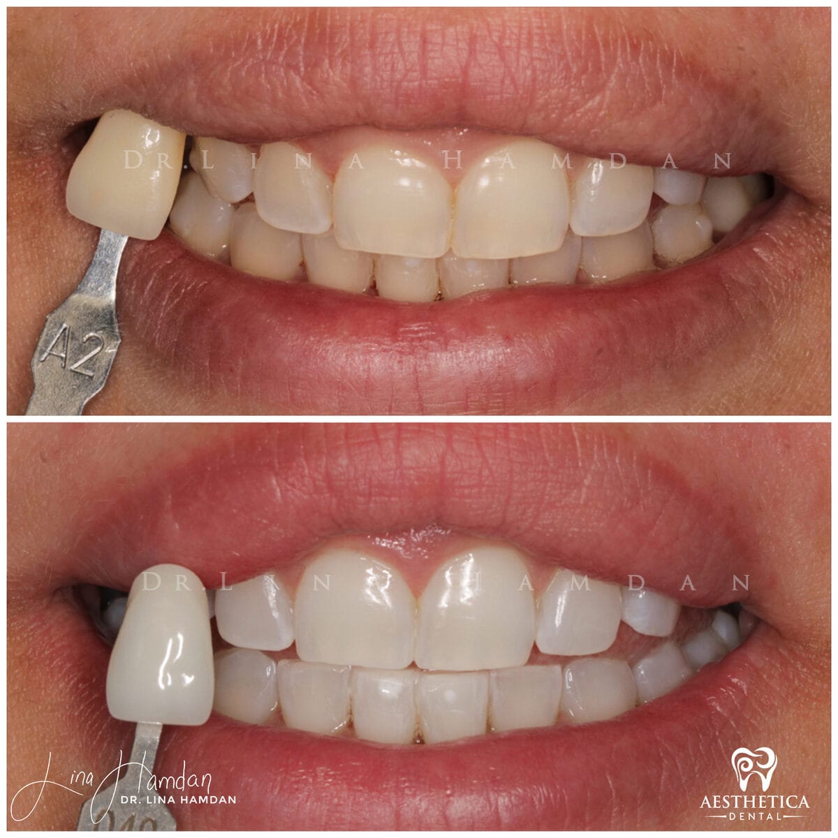 Teeth whitening: anonymous case 14 from Aesthetica Dental Naperville