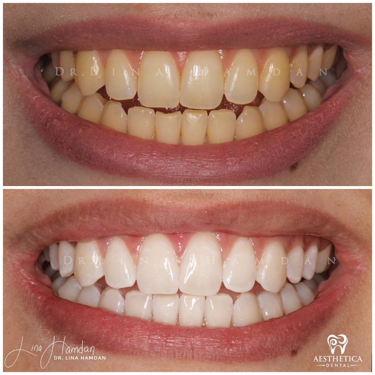 Teeth whitening: anonymous case 15 from Aesthetica Dental Naperville
