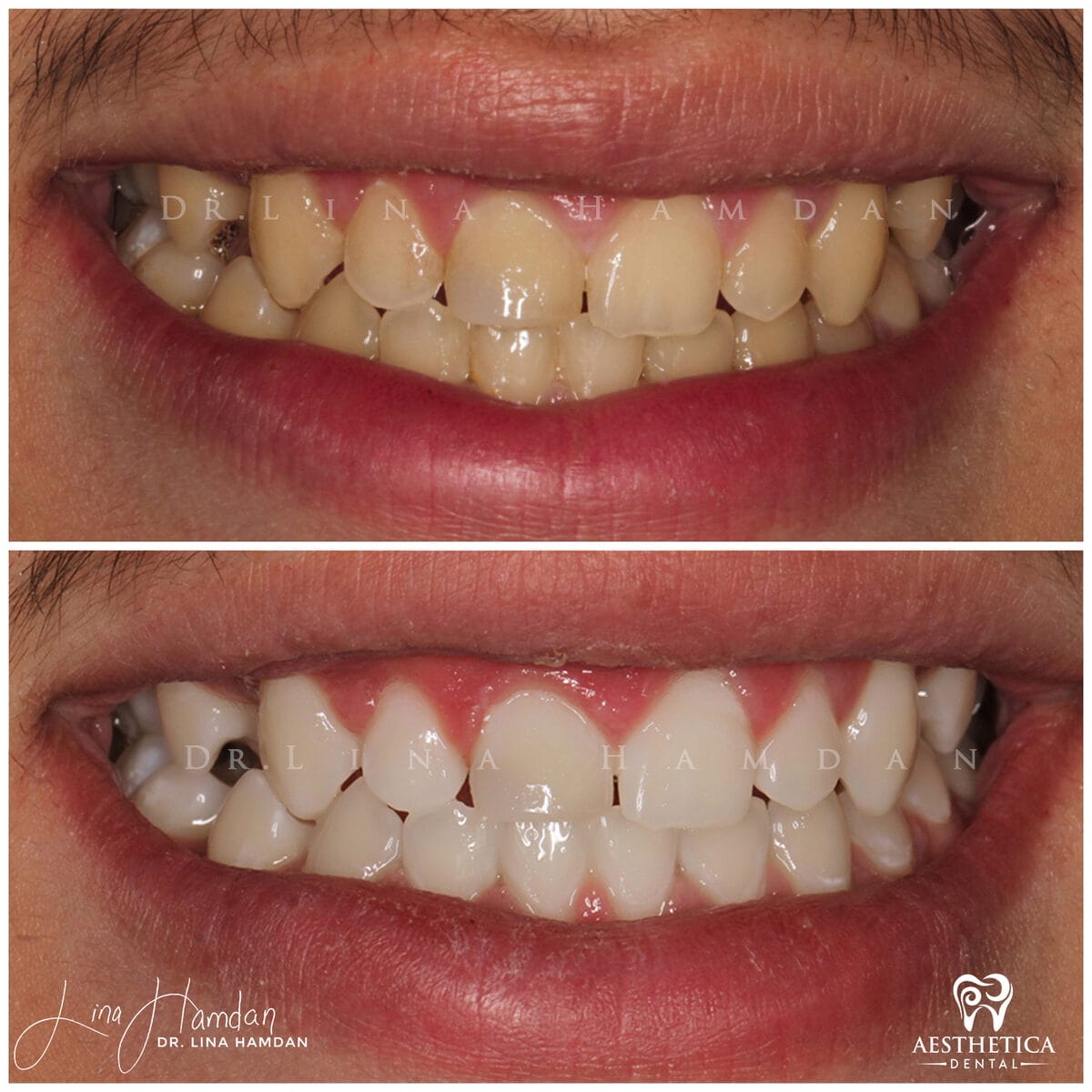 Teeth whitening: anonymous case 17 from Aesthetica Dental Naperville