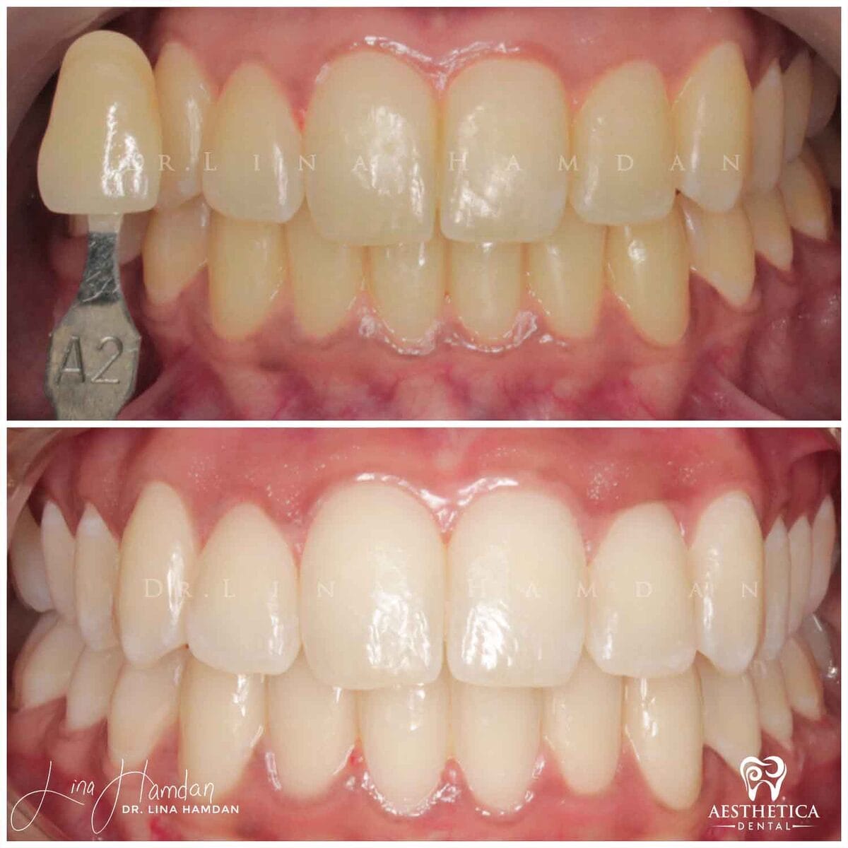 Teeth whitening: anonymous case 18 from Aesthetica Dental Naperville
