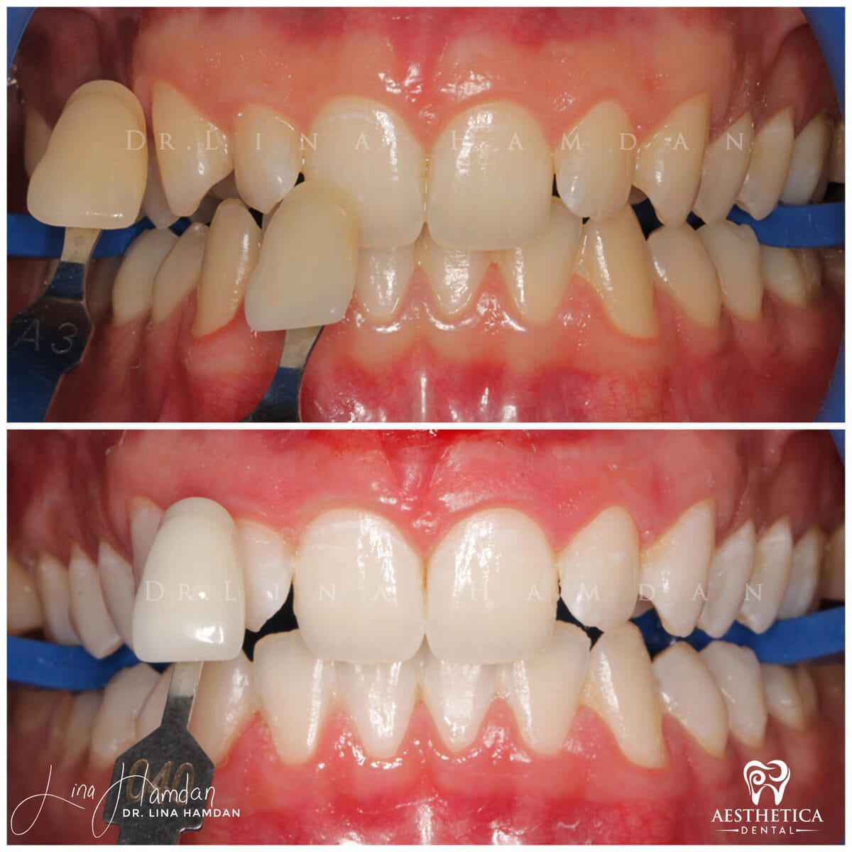 Teeth whitening: anonymous case 19 from Aesthetica Dental Naperville