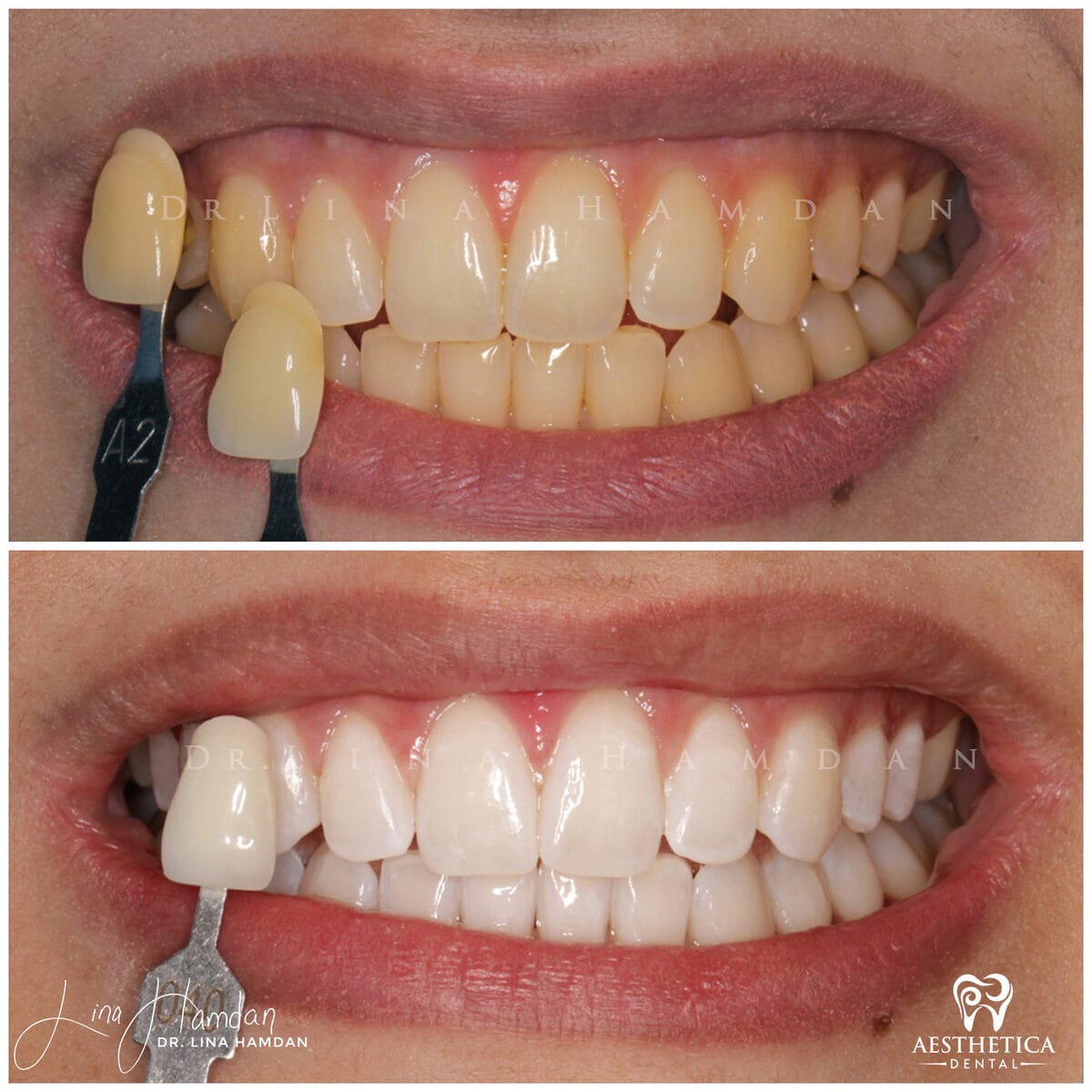 Teeth whitening: anonymous case 22 from Aesthetica Dental Naperville