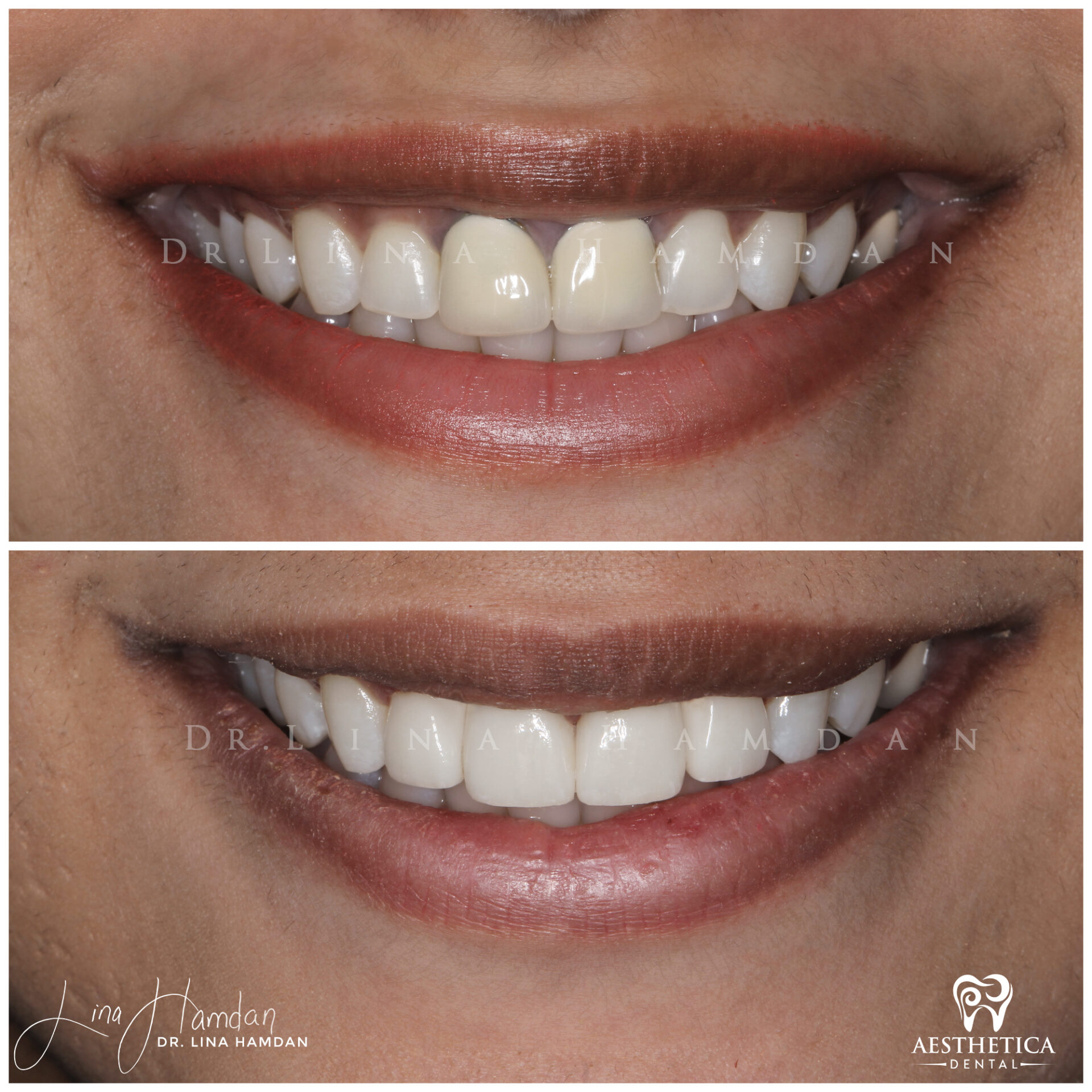 Porcelain Veneers case 8 done by Dr. Lina Hamdan. - Before and After Images - 1