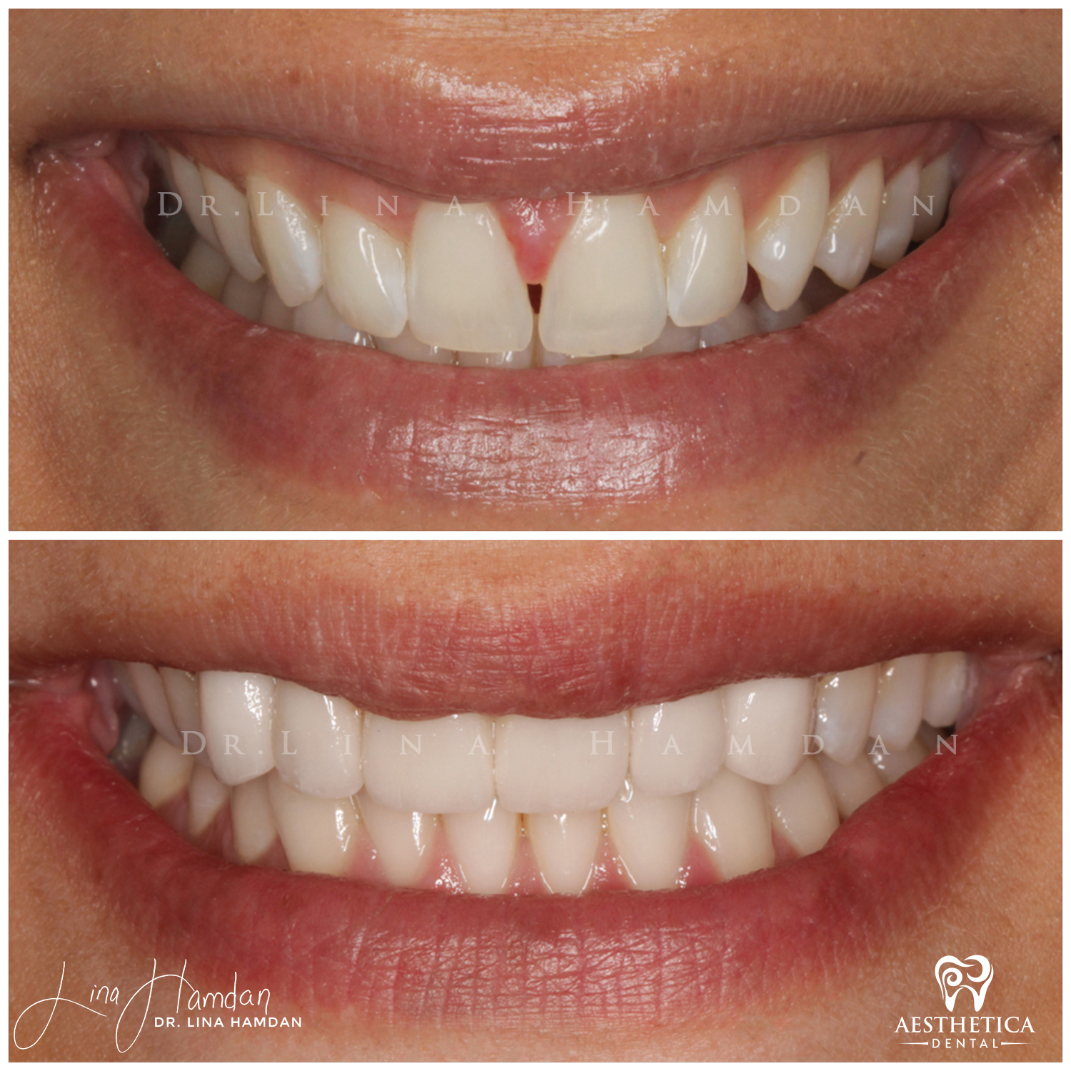 Porcelain Veneers case 9 done by Dr. Lina Hamdan. - Before and After Images - 1