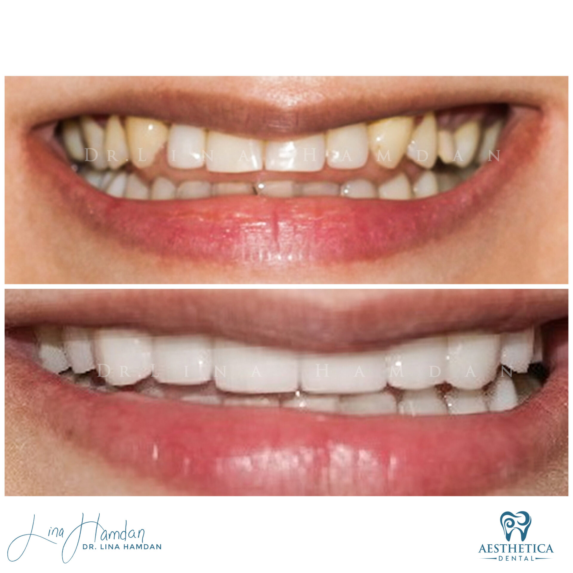 Porcelain Veneers case 10 done by Dr. Lina Hamdan. - Before and After Images - 1
