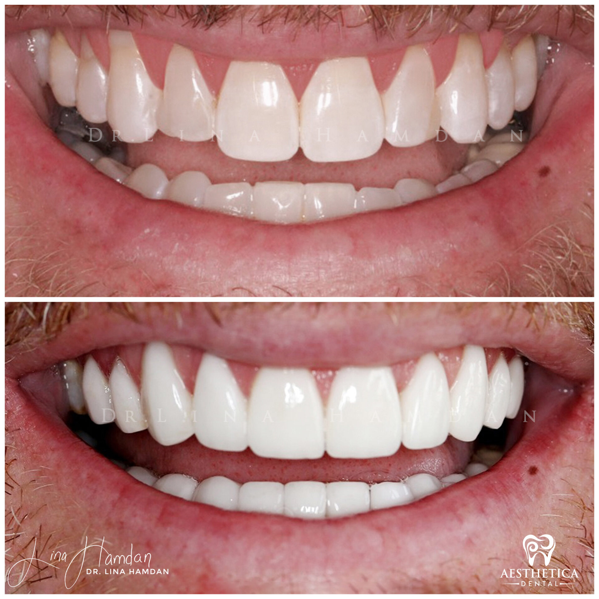 Porcelain Veneers case 1 done by Dr. Lina Hamdan. - Before and After Images - 3