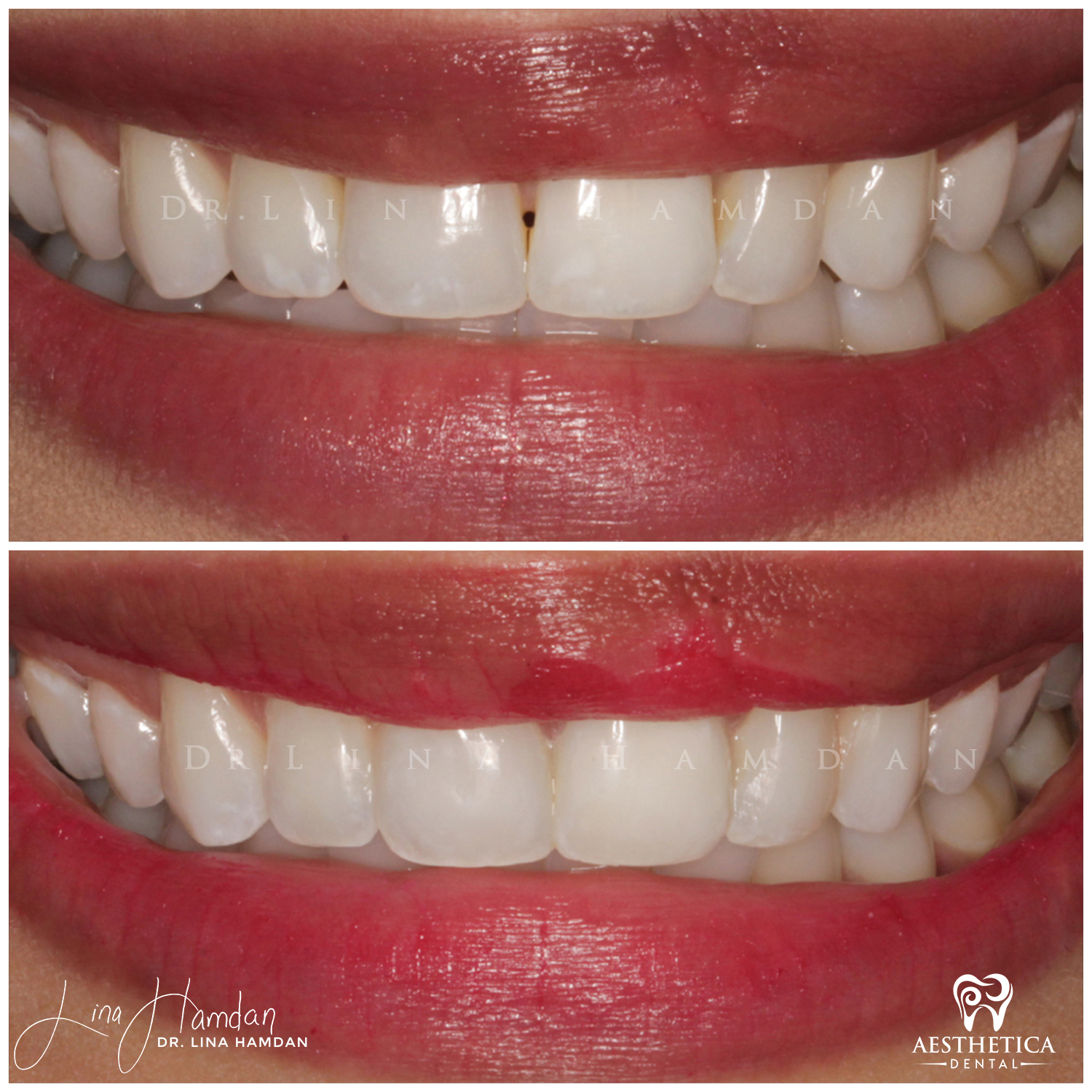 Dental Composite Bonding case done by Dr. Lina Hamdan. - Before and After Images - 1
