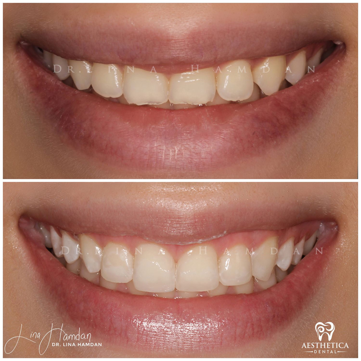 Dental Composite Bonding case 2 done by Dr. Lina Hamdan. - Before and After Images - 3
