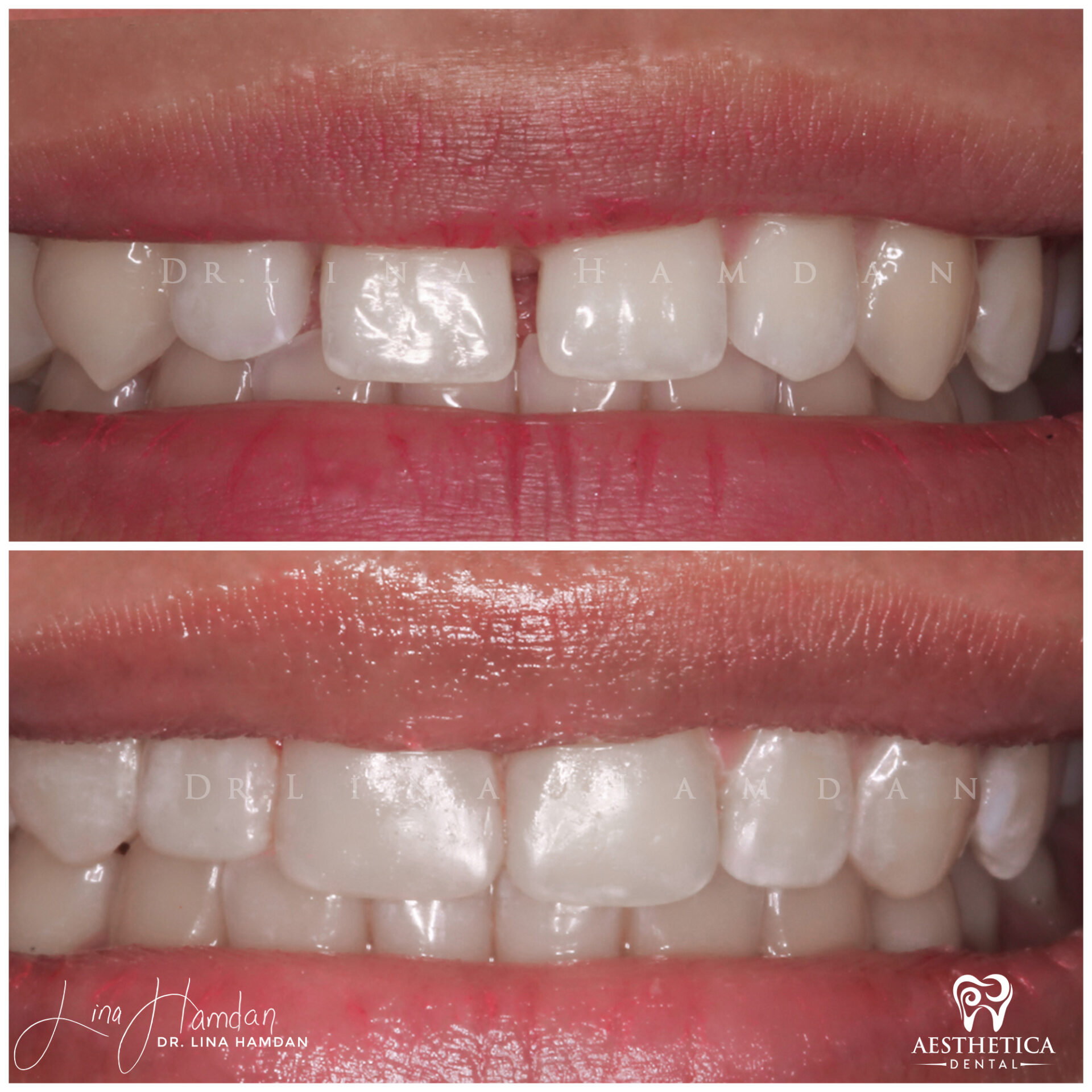 Dental Composite Bonding case 3 done by Dr. Lina Hamdan. - Before and After Images - 2