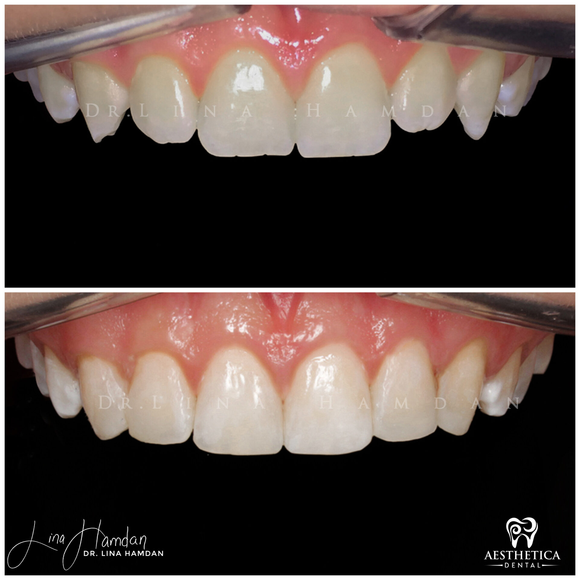 Dental Composite Bonding case 4 done by Dr. Lina Hamdan. - Before and After Images - 2