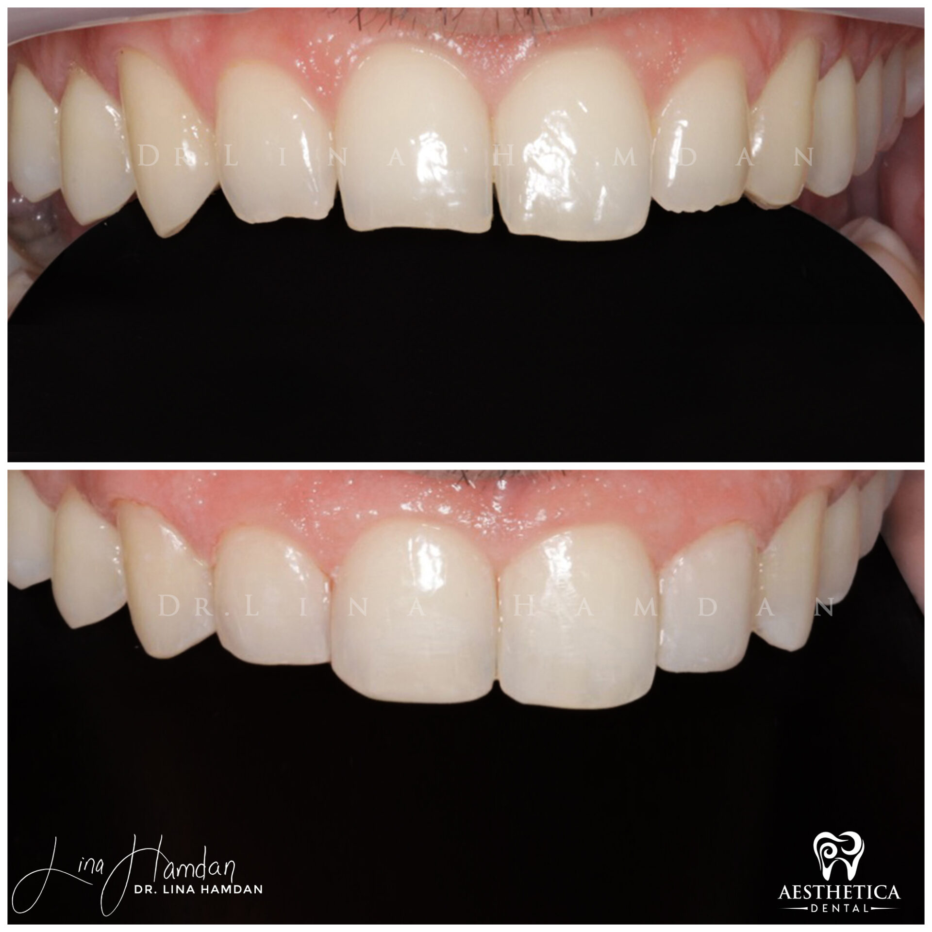 Dental Composite Bonding case 5 done by Dr. Lina Hamdan. - Before and After Images - 3