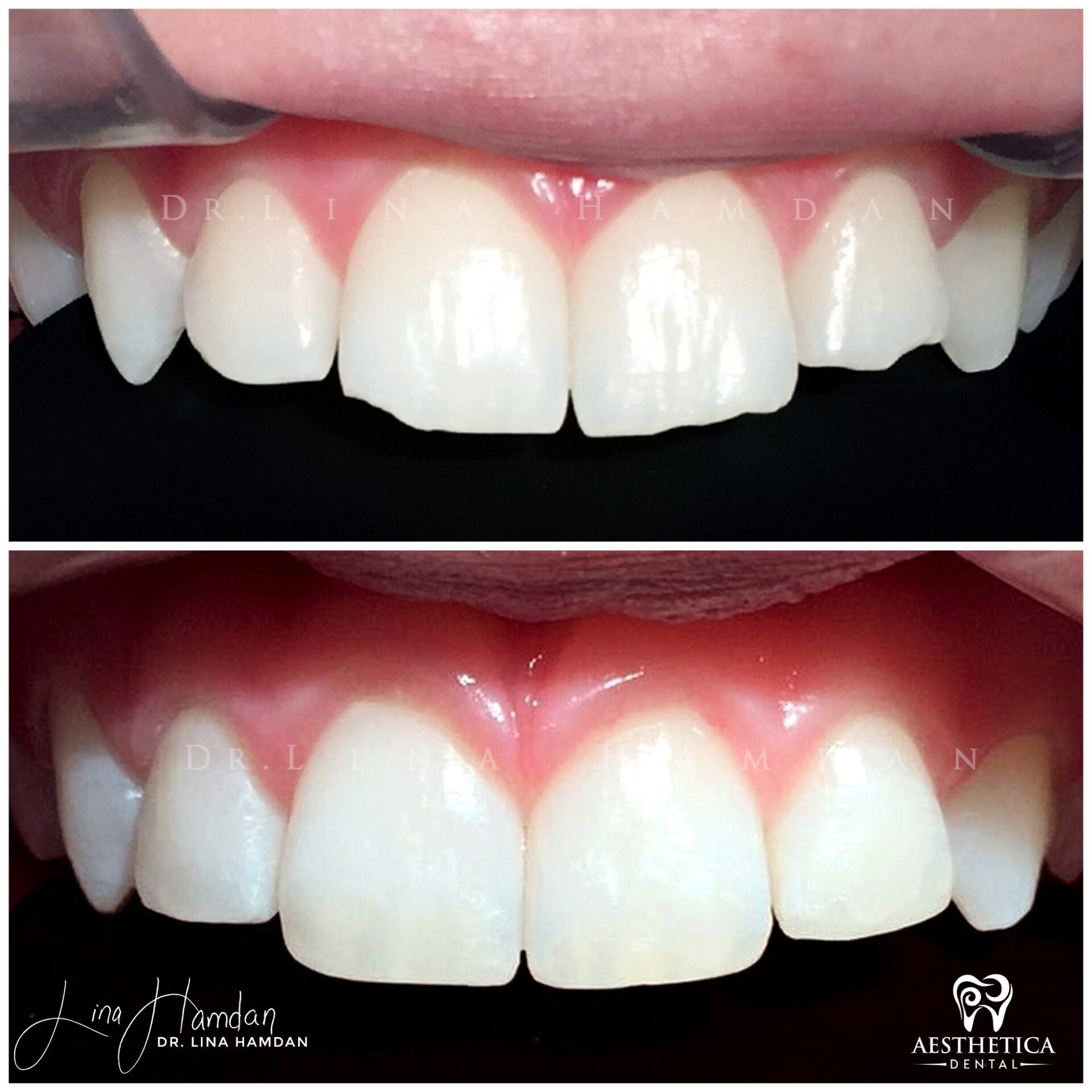 Dental Composite Bonding case 6 done by Dr. Lina Hamdan. - Before and After Images - 2