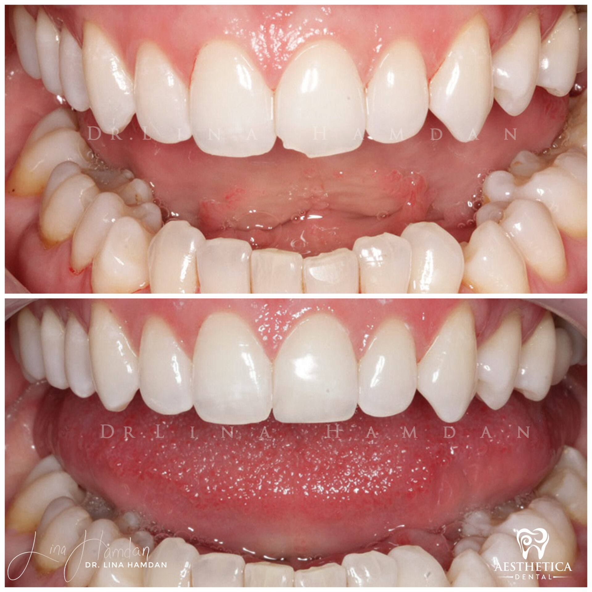Dental Composite Bonding case 9 done by Dr. Lina Hamdan. - Before and After Images - 2