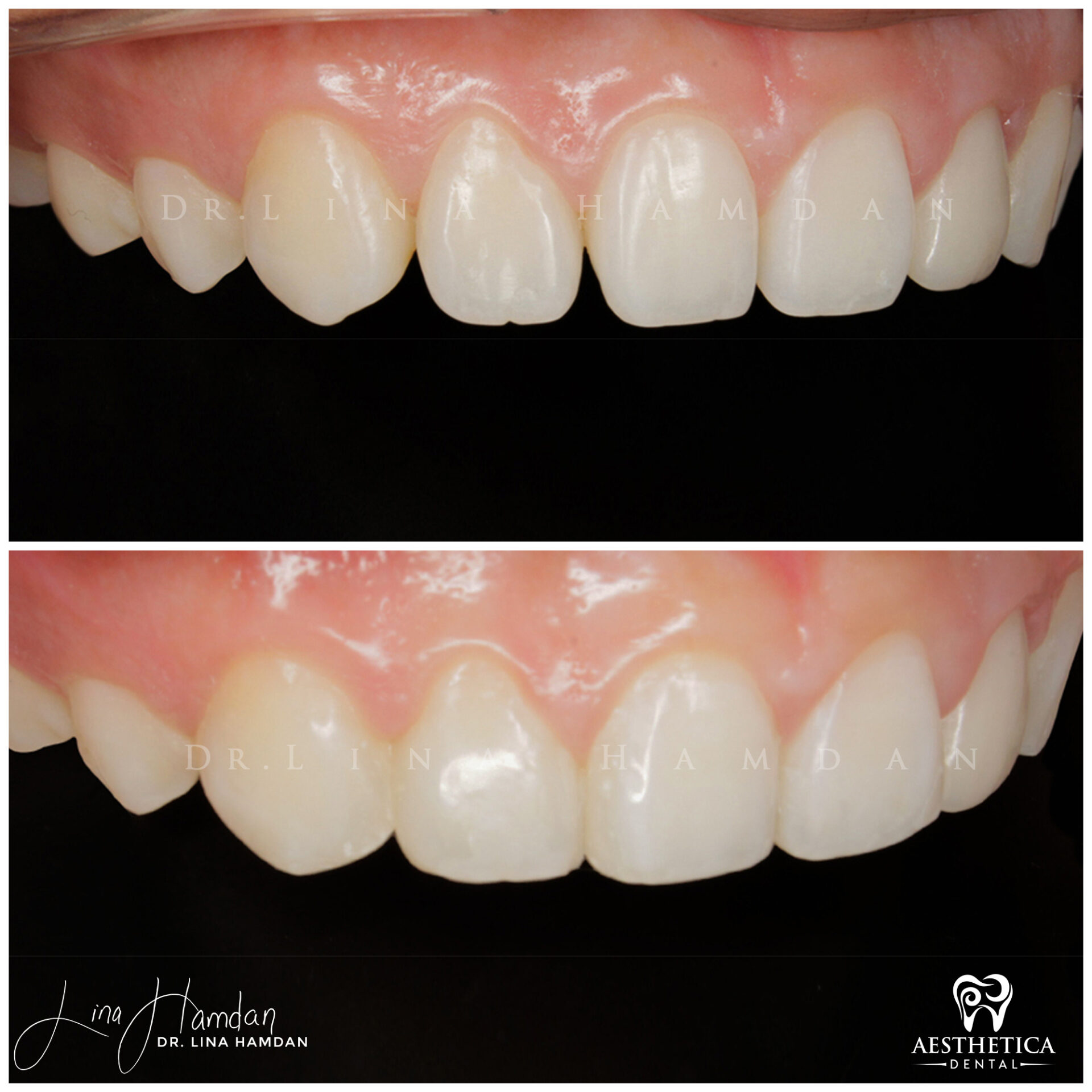 Dental Composite Bonding case 11 done by Dr. Lina Hamdan. - Before and After Images - 3