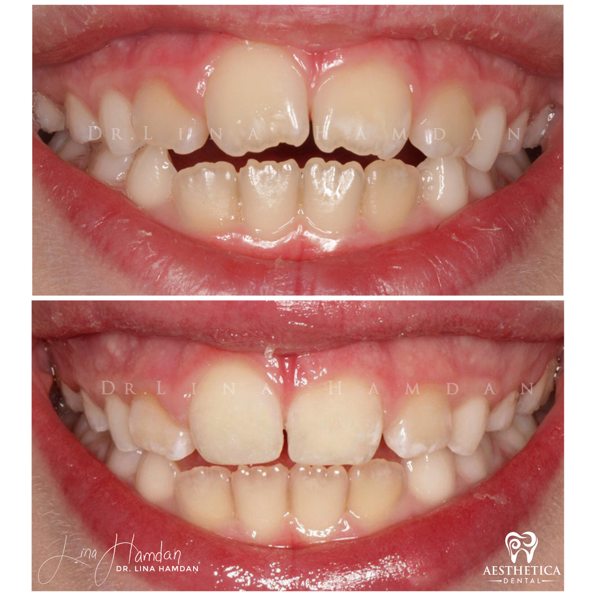 Dental Composite Bonding case 14 done by Dr. Lina Hamdan. - Before and After Images - 2