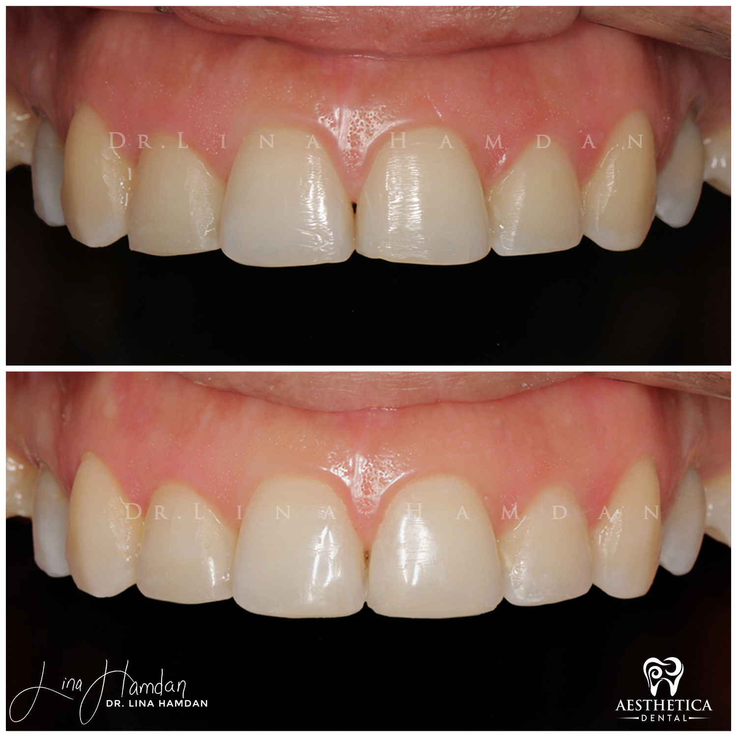 Dental Composite Bonding case 15 done by Dr. Lina Hamdan. - Before and After Images - 3