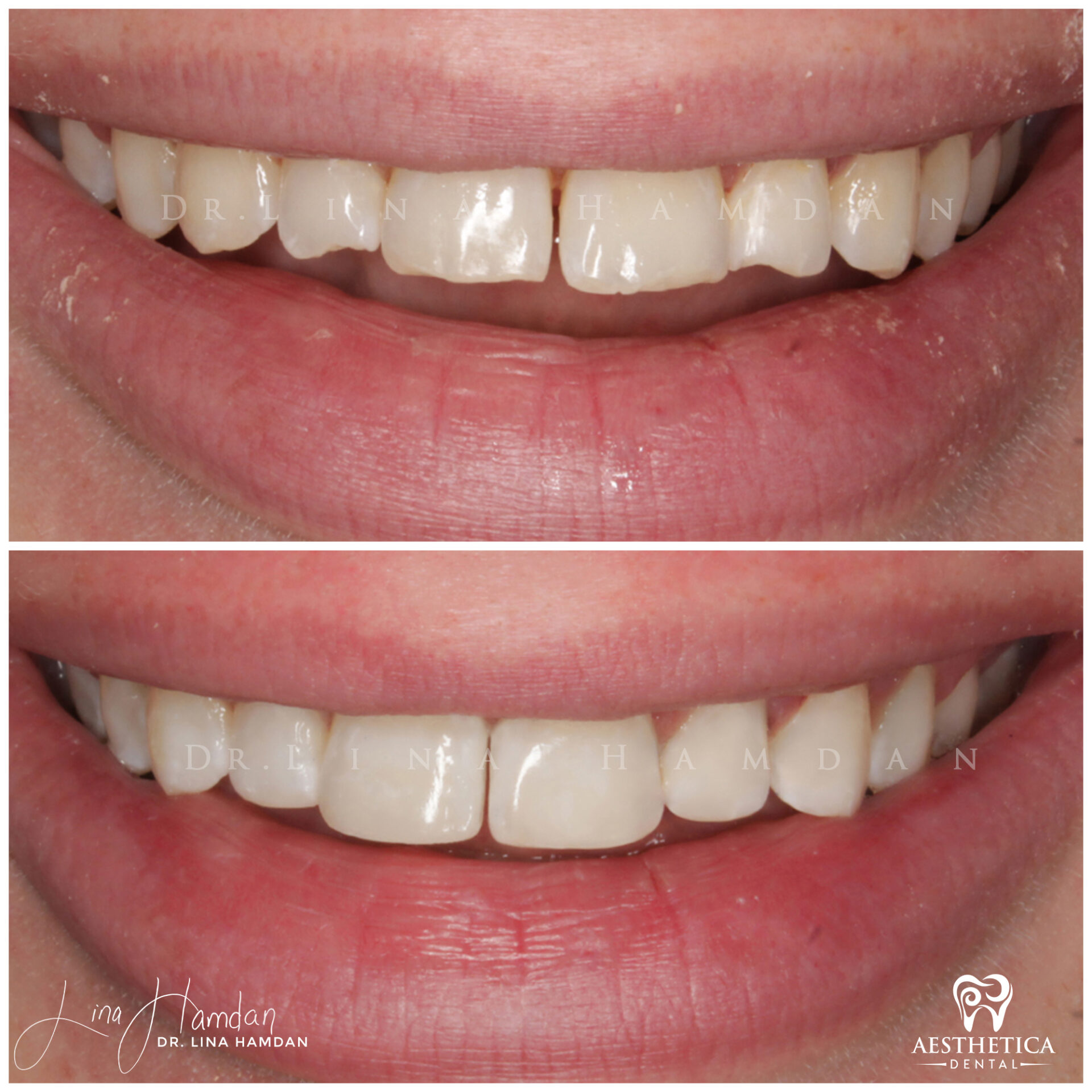 Dental Composite Bonding case 17 done by Dr. Lina Hamdan. - Before and After Images - 2