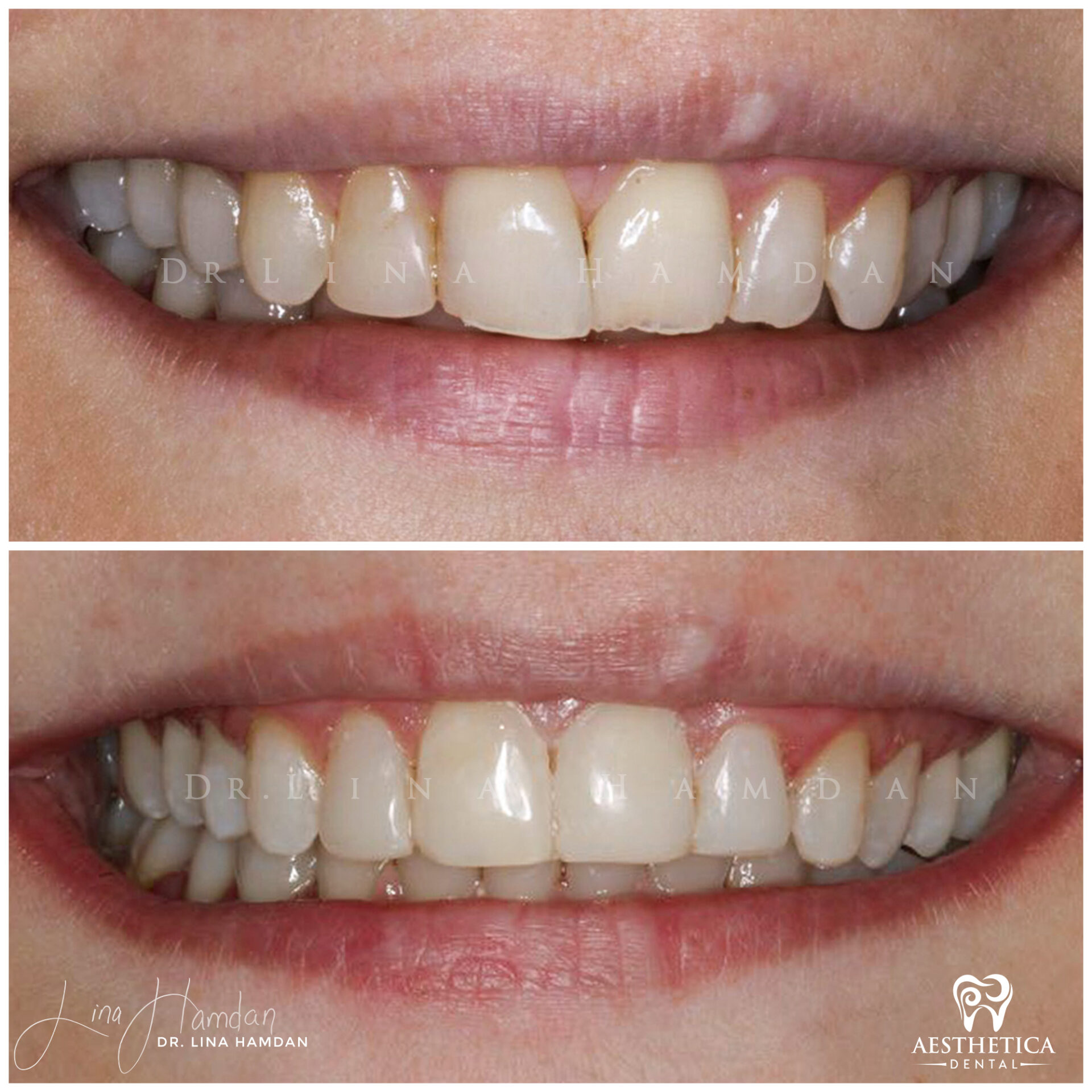 Dental Composite Bonding case 19 done by Dr. Lina Hamdan. - Before and After Images - 2