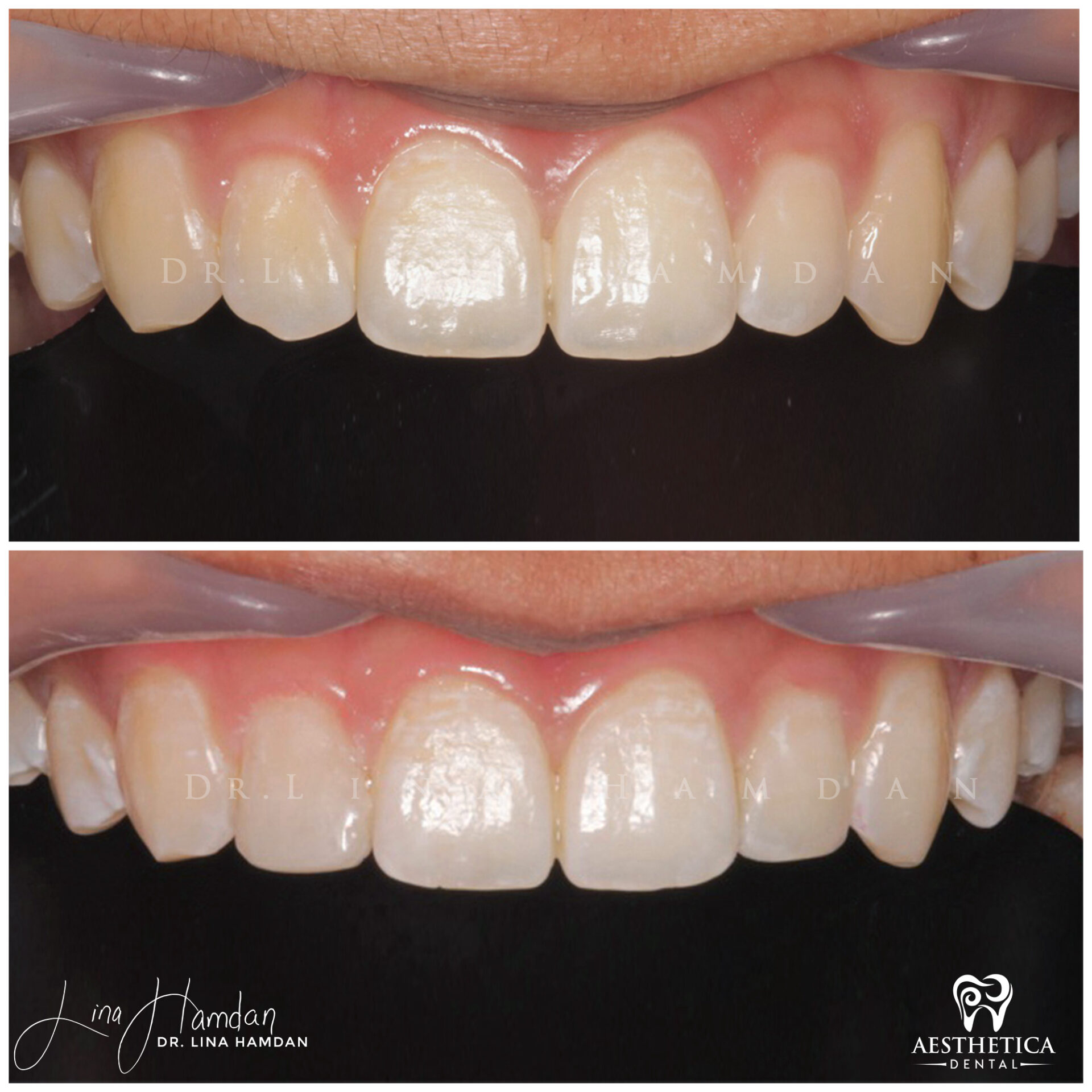 Dental Composite Bonding case 20 done by Dr. Lina Hamdan. - Before and After Images - 2