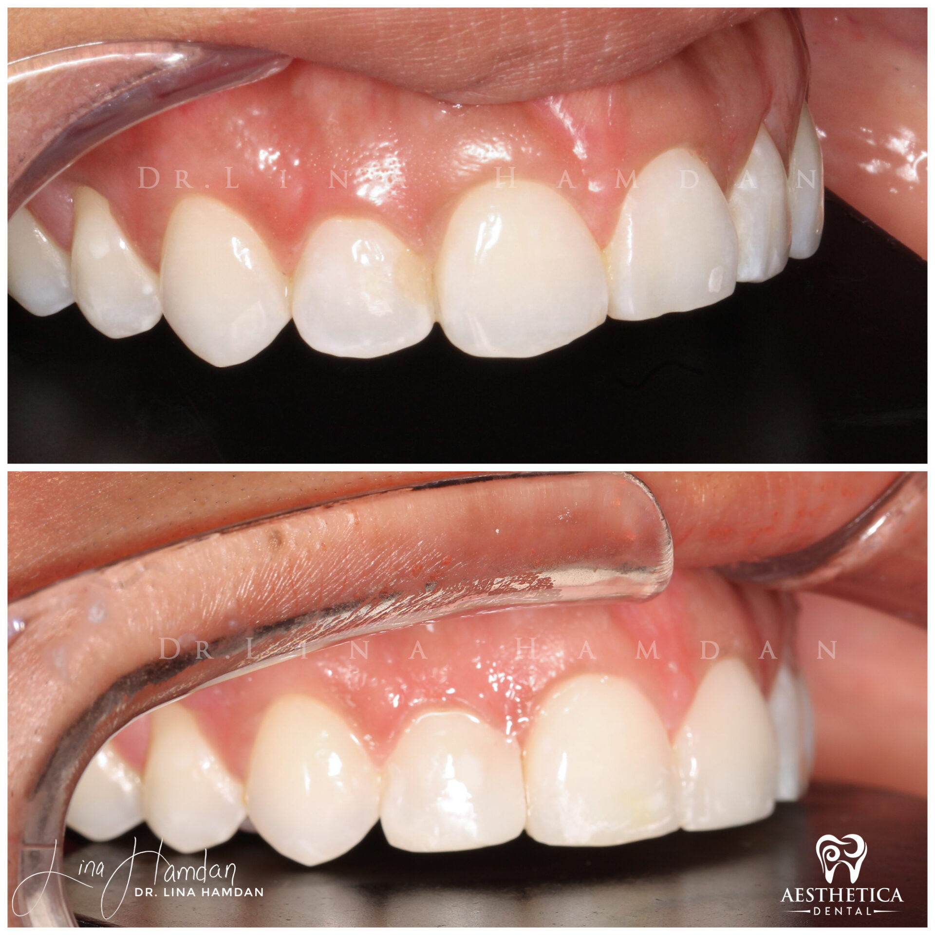 Dental Composite Bonding case 21 done by Dr. Lina Hamdan. - Before and After Images - 6