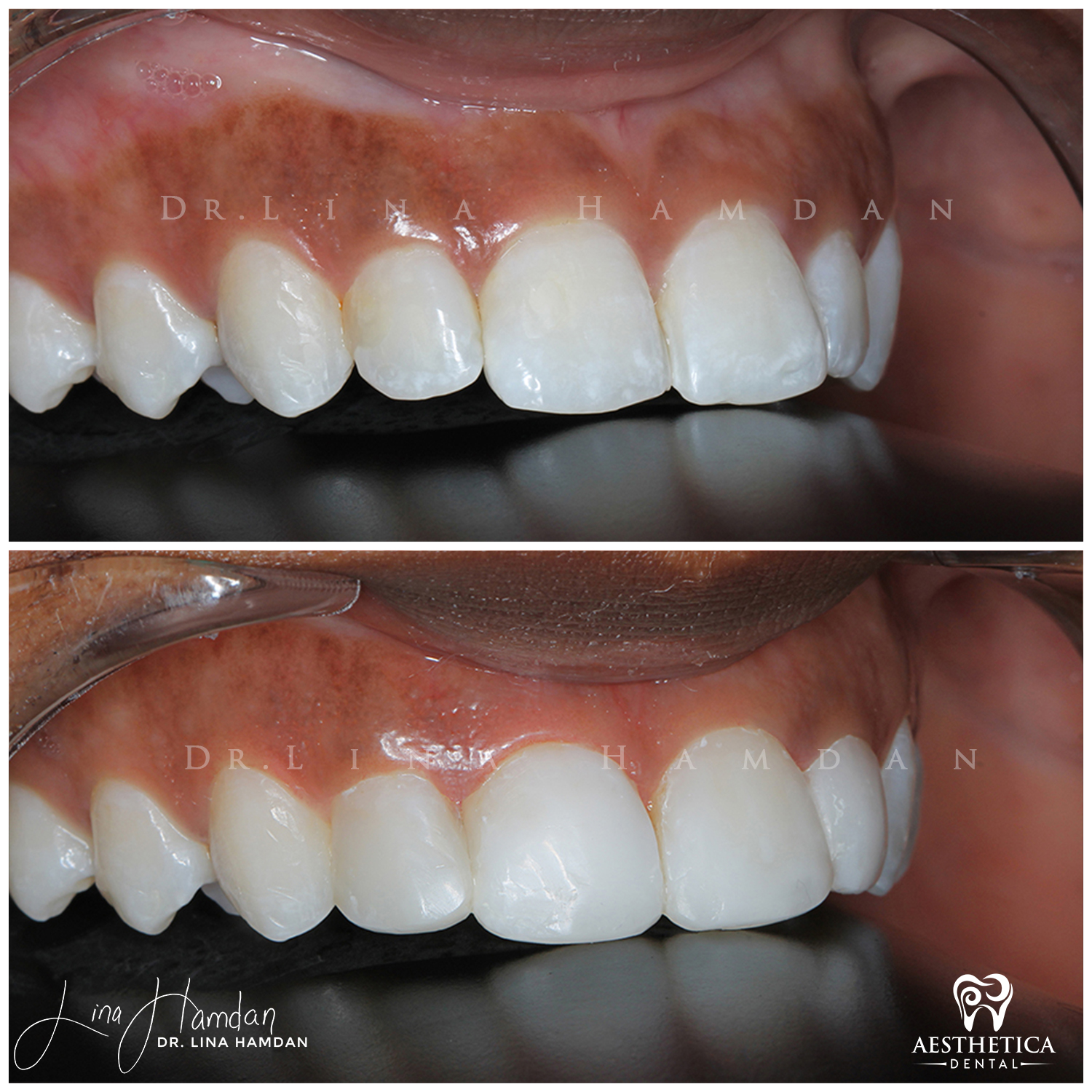 Dental Composite Bonding case 13 done by Dr. Lina Hamdan. - Before and After Images - 4