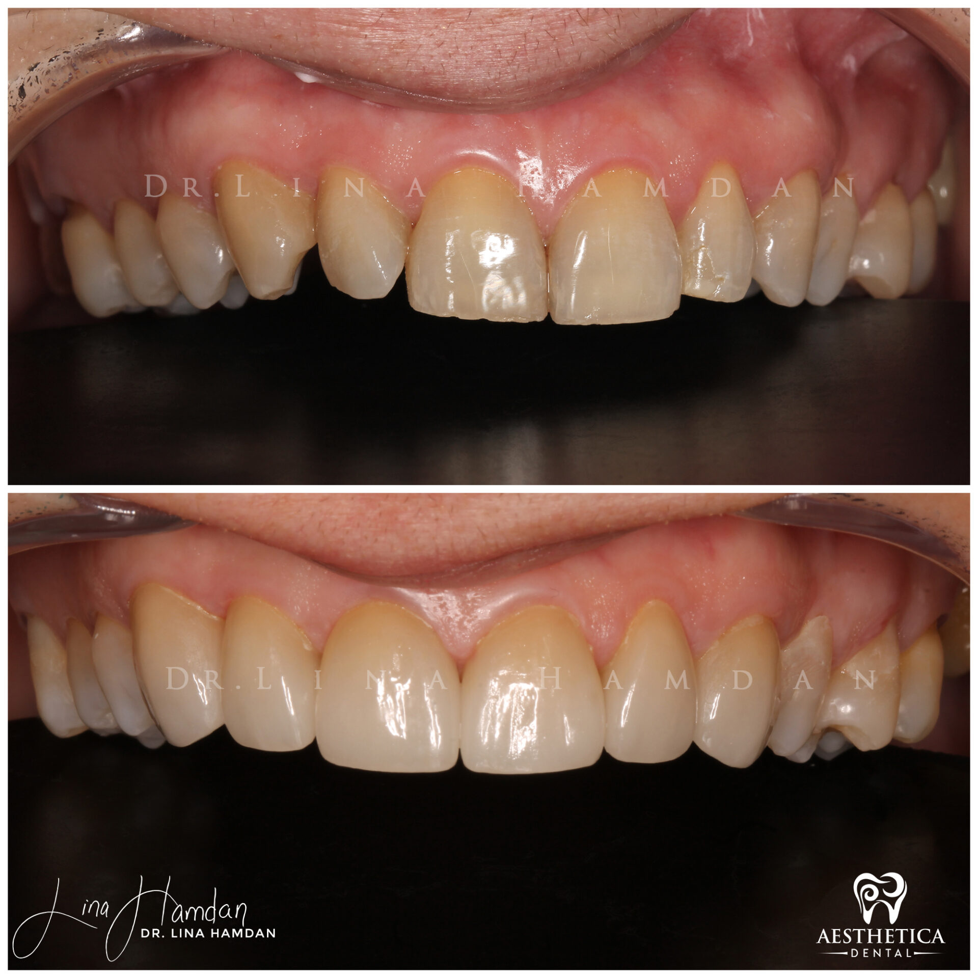 Porcelain Veneers case 5 done by Dr. Lina Hamdan. - Before and After Images - 8