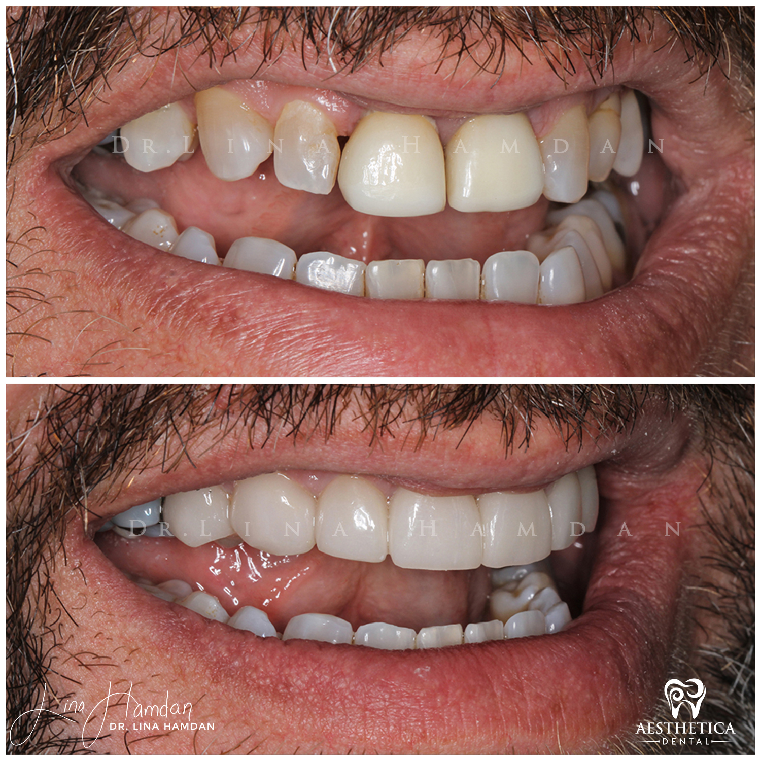 Porcelain Veneers case 6 done by Dr. Lina Hamdan. - Before and After Images - 8