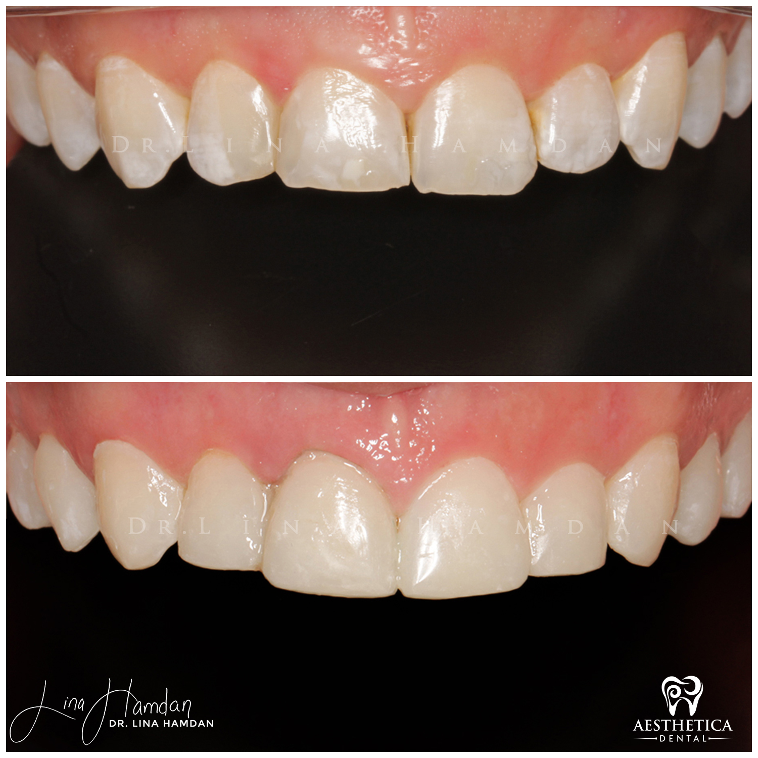 Dental Composite Bonding case 1 done by Dr. Lina Hamdan. - Before and After Images - 5