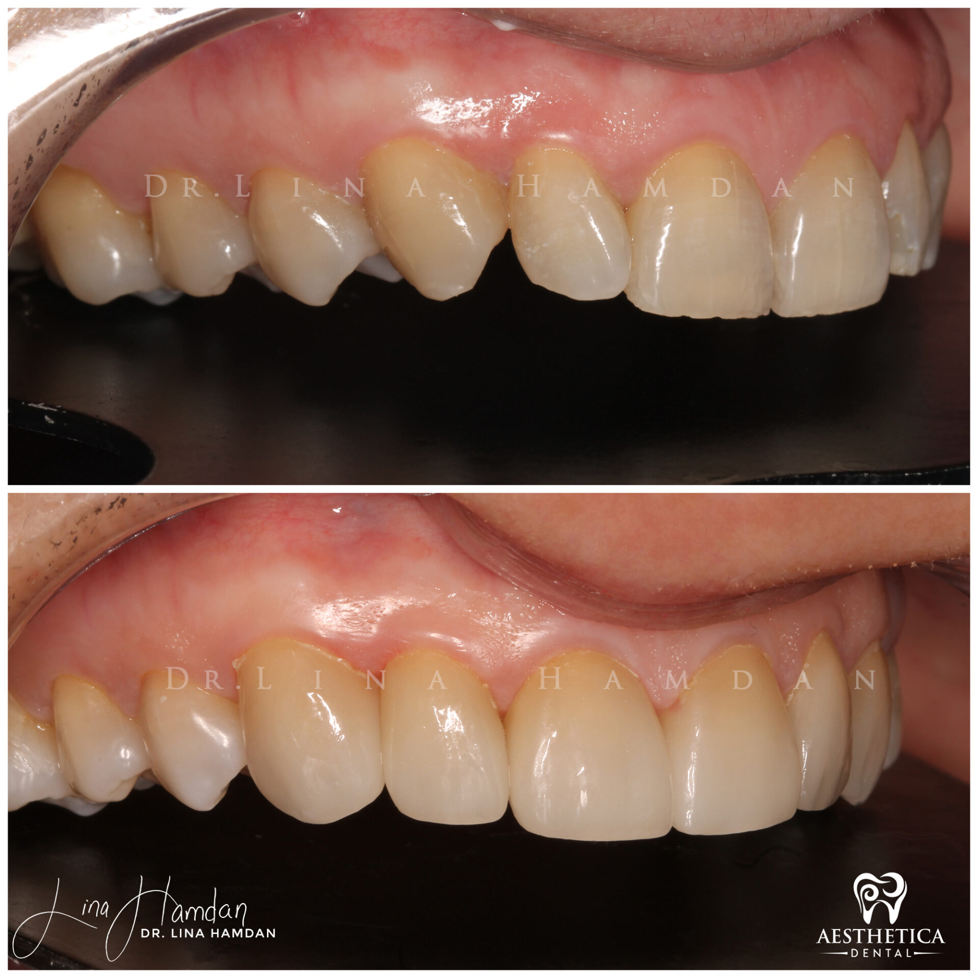 Porcelain Veneers case 5 done by Dr. Lina Hamdan. - Before and After Images - 9
