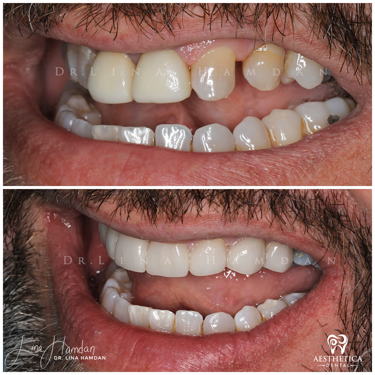 Porcelain Veneers case 6 done by Dr. Lina Hamdan. - Before and After Images - 9