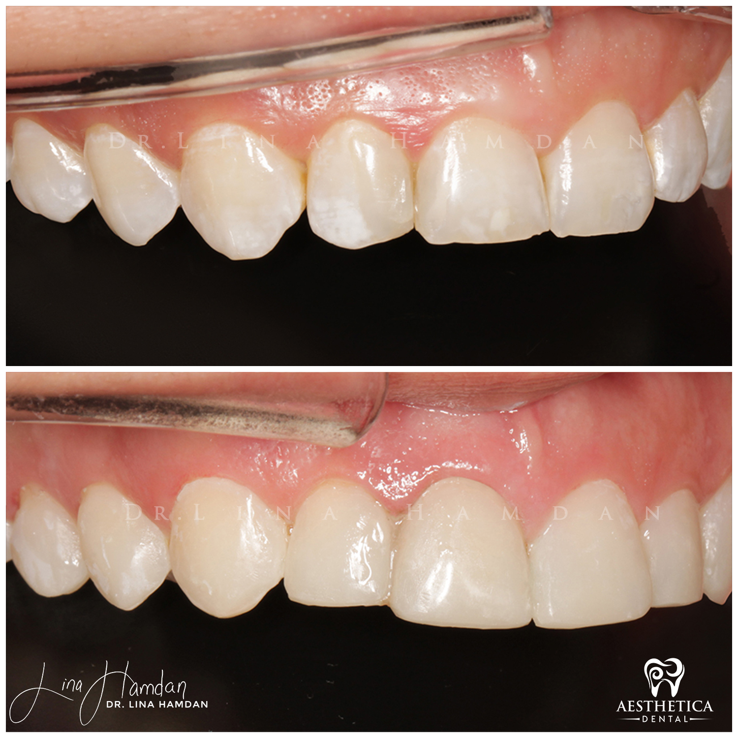 Dental Composite Bonding case 1 done by Dr. Lina Hamdan. - Before and After Images - 6
