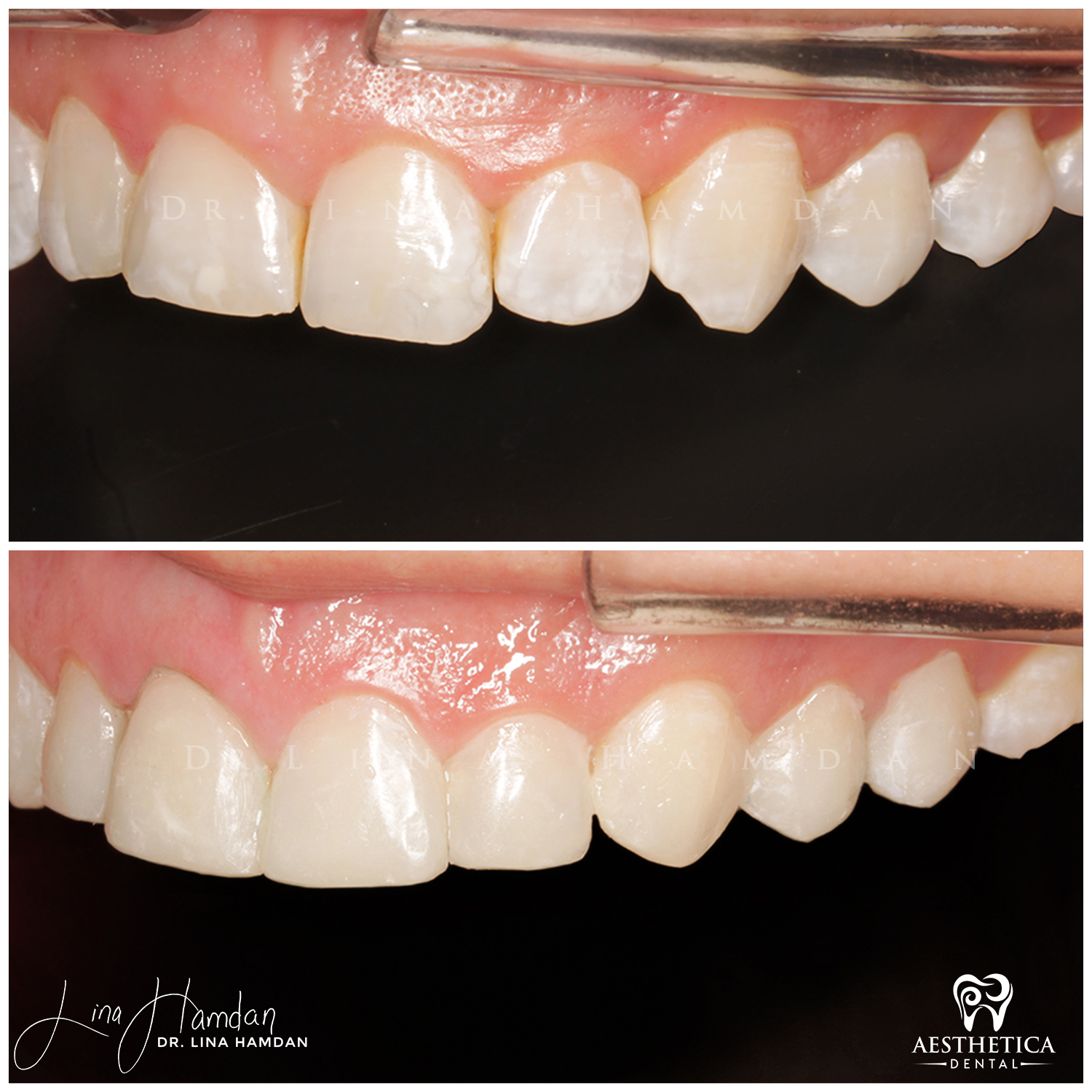 Dental Composite Bonding case 1 done by Dr. Lina Hamdan. - Before and After Images - 7