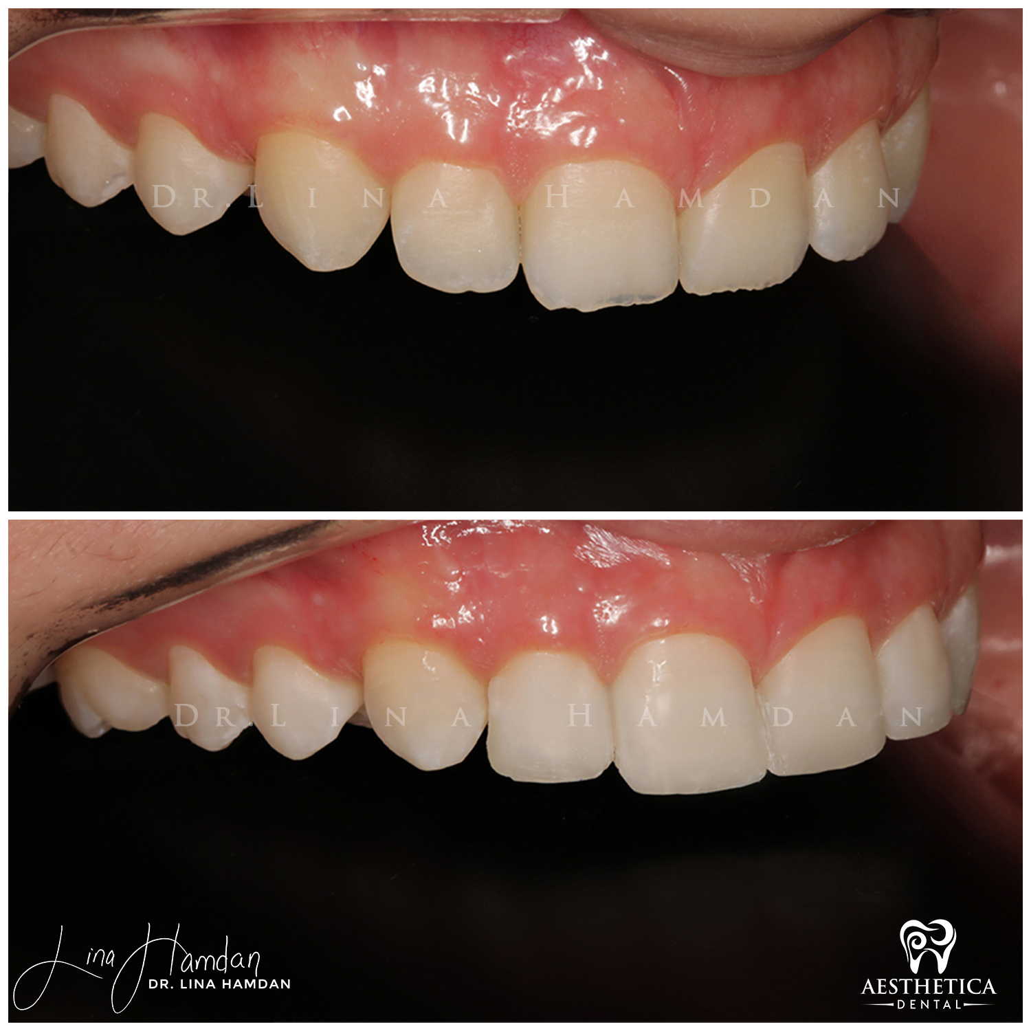 Dental Composite Bonding case 2 done by Dr. Lina Hamdan. - Before and After Images - 8
