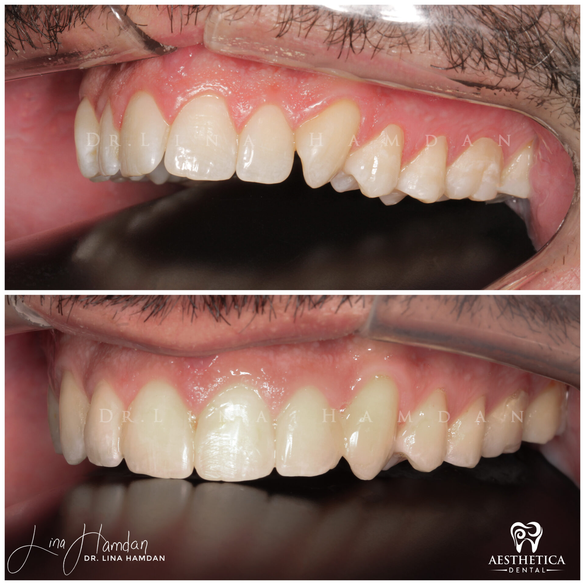 Dental Composite Bonding case 16 done by Dr. Lina Hamdan. - Before and After Images - 5