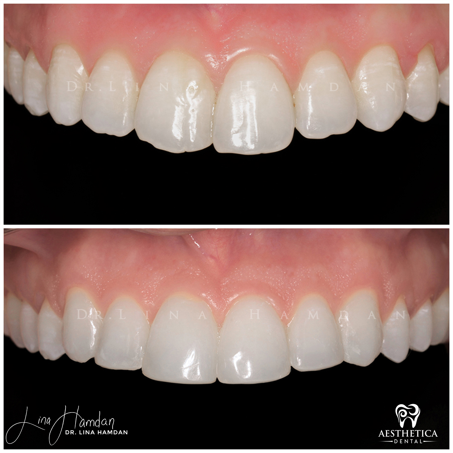 Dental Composite Bonding case 18 done by Dr. Lina Hamdan. - Before and After Images - 6