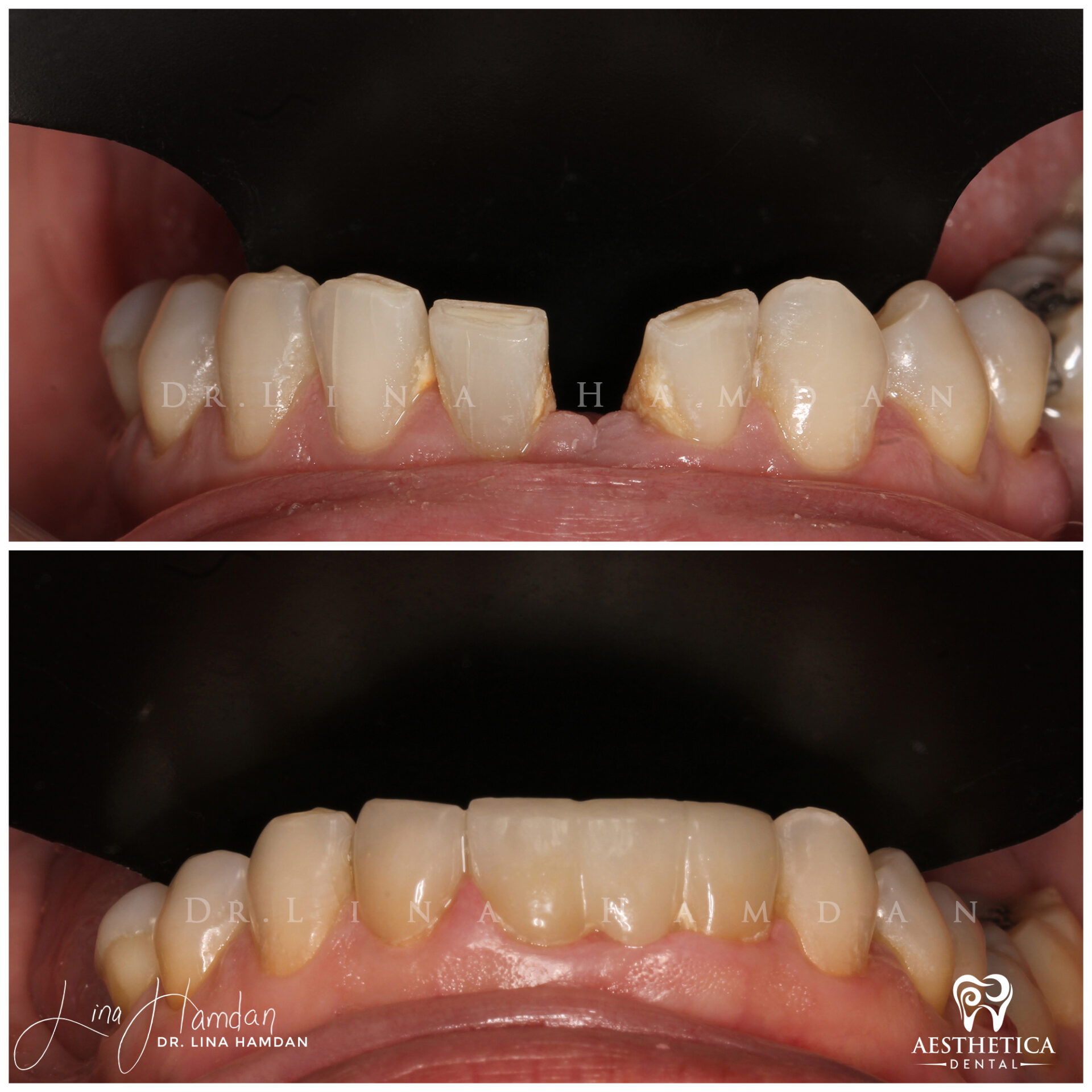 Porcelain Veneers case 5 done by Dr. Lina Hamdan. - Before and After Images - 11