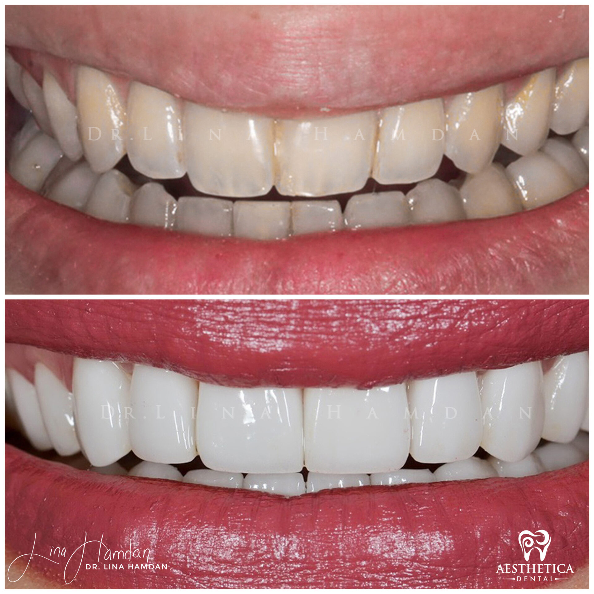 Porcelain Veneers case 3 done by Dr. Lina Hamdan. - Before and After Images - 4
