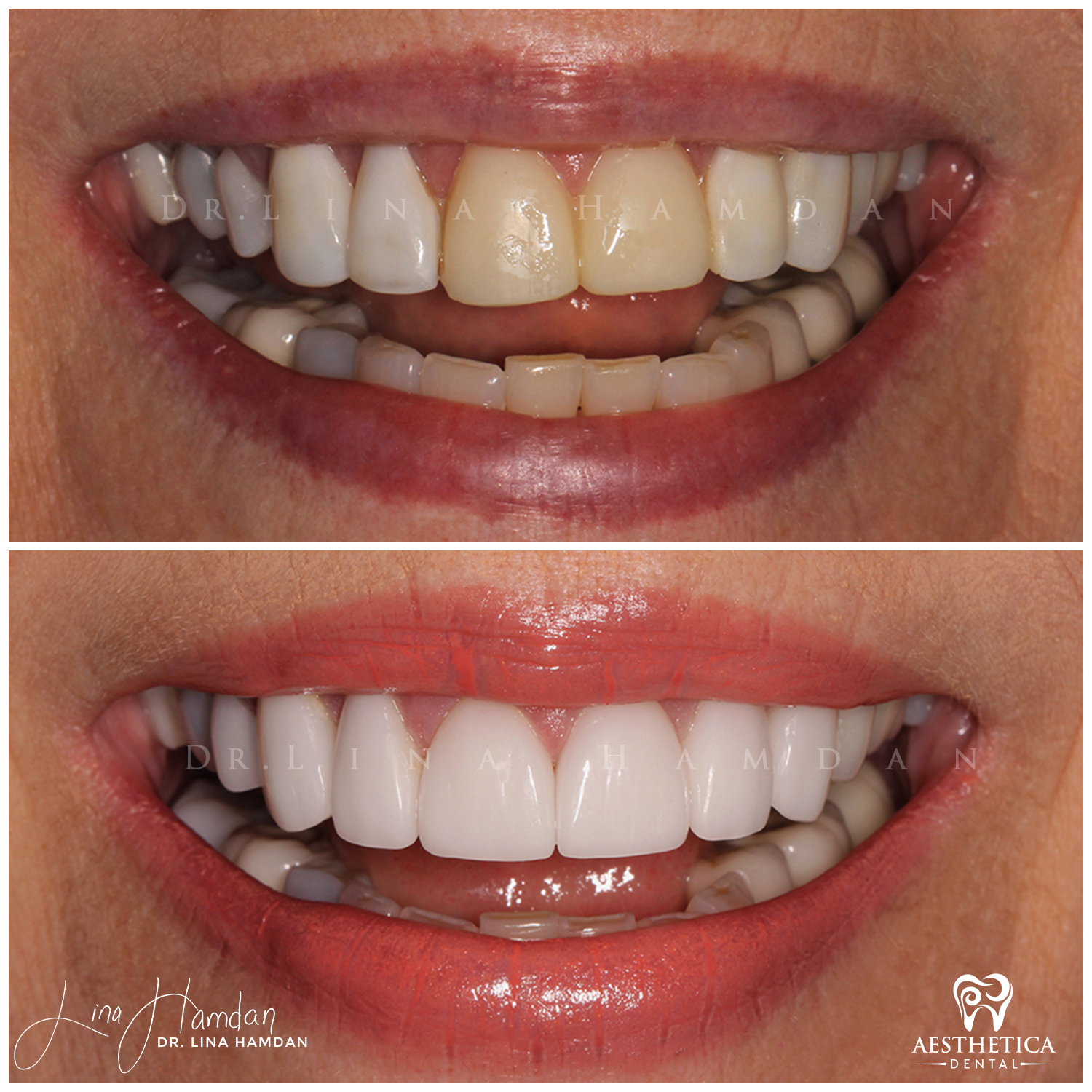 Porcelain Veneers case 2 done by Dr. Lina Hamdan. - Before and After Images - 6