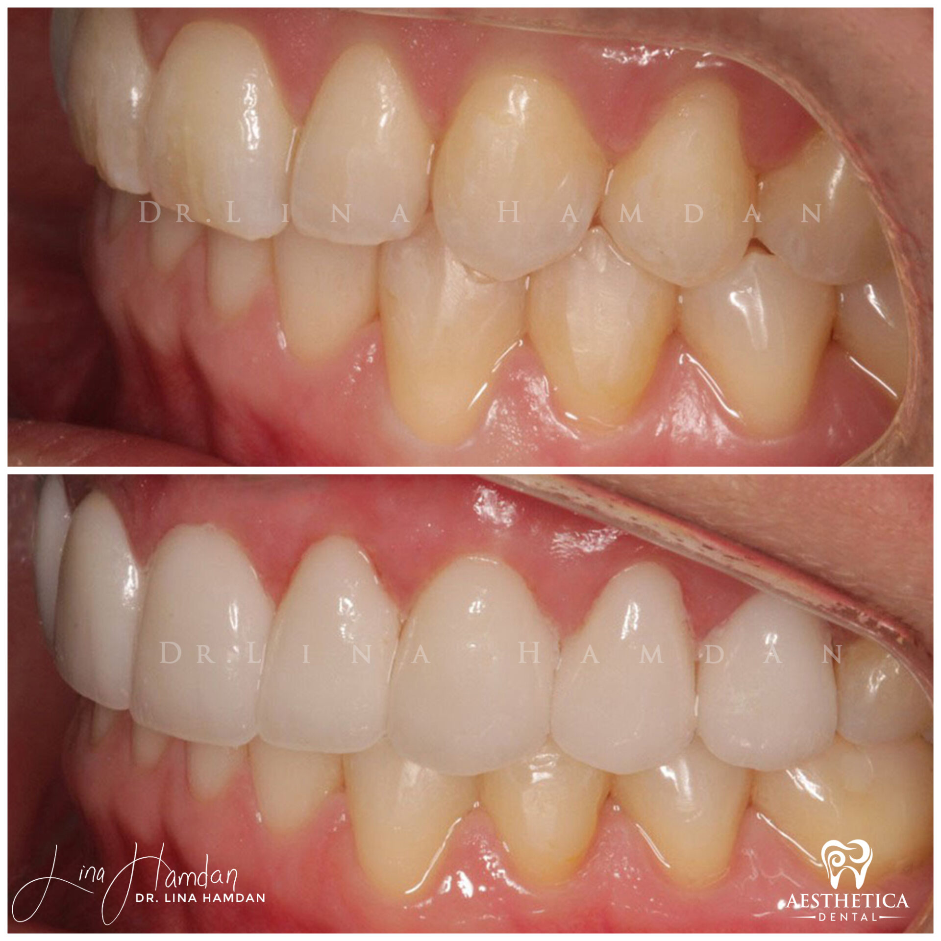 Porcelain Veneers case 4 done by Dr. Lina Hamdan. - Before and After Images - 4
