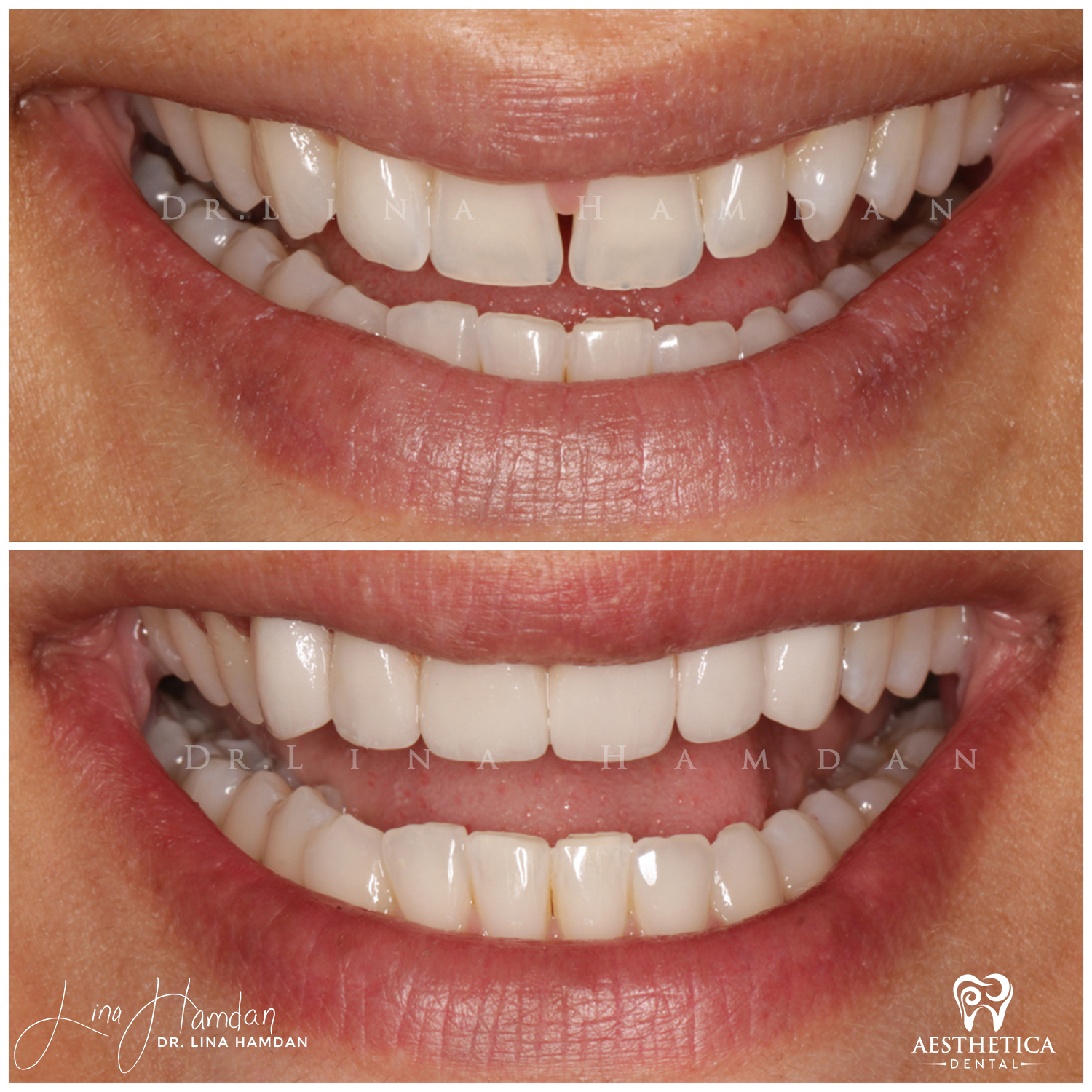 Porcelain Veneers case 9 done by Dr. Lina Hamdan. - Before and After Images - 2