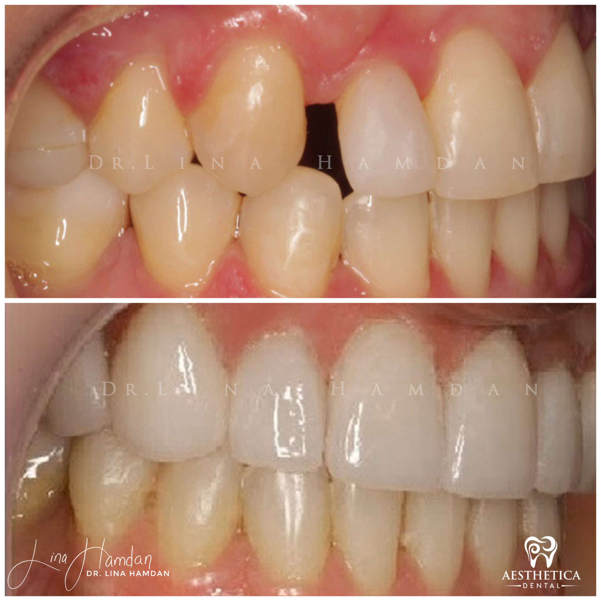 Porcelain Veneers case 10 done by Dr. Lina Hamdan. - Before and After Images - 2