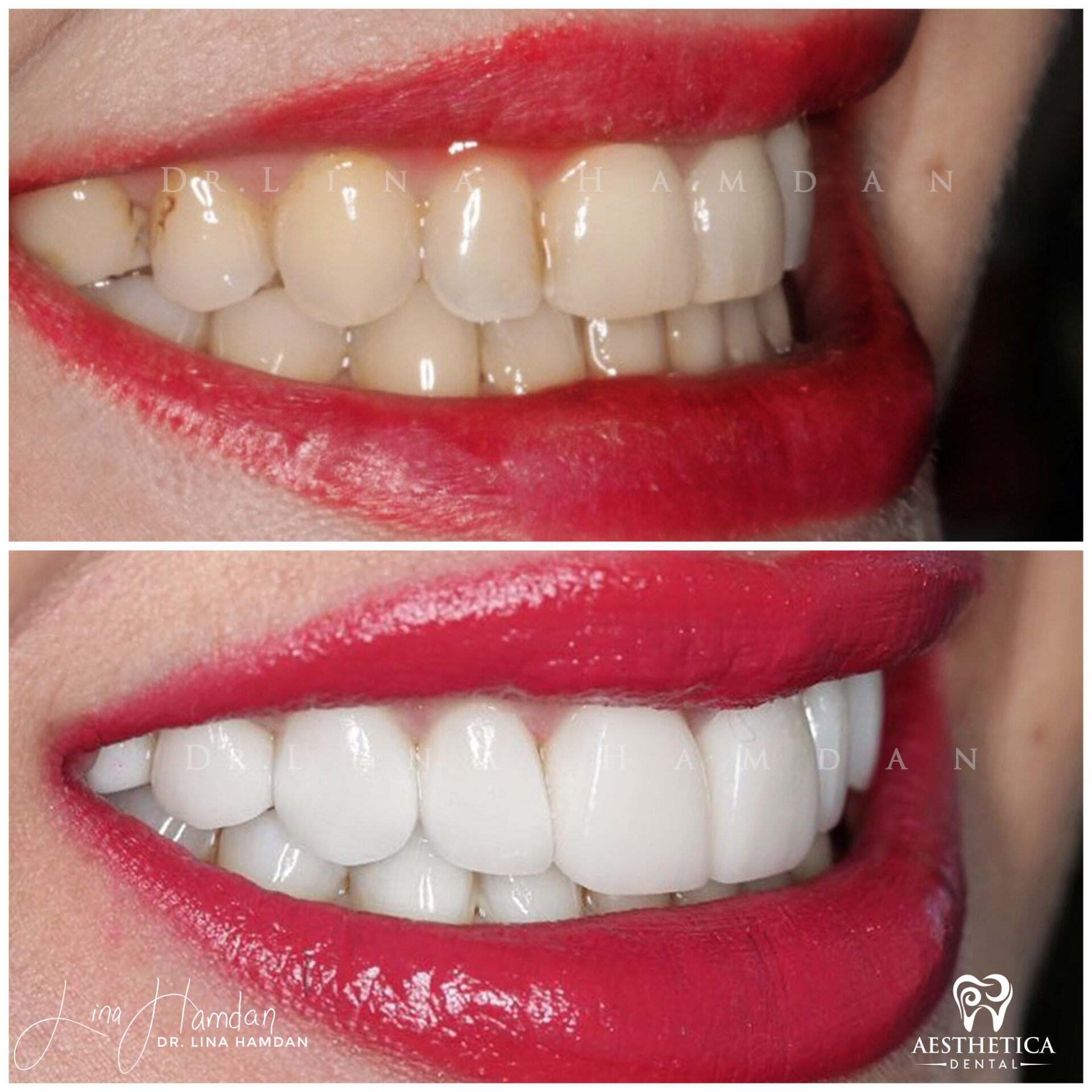 Porcelain Veneers case 7 done by Dr. Lina Hamdan. - Before and After Images - 4