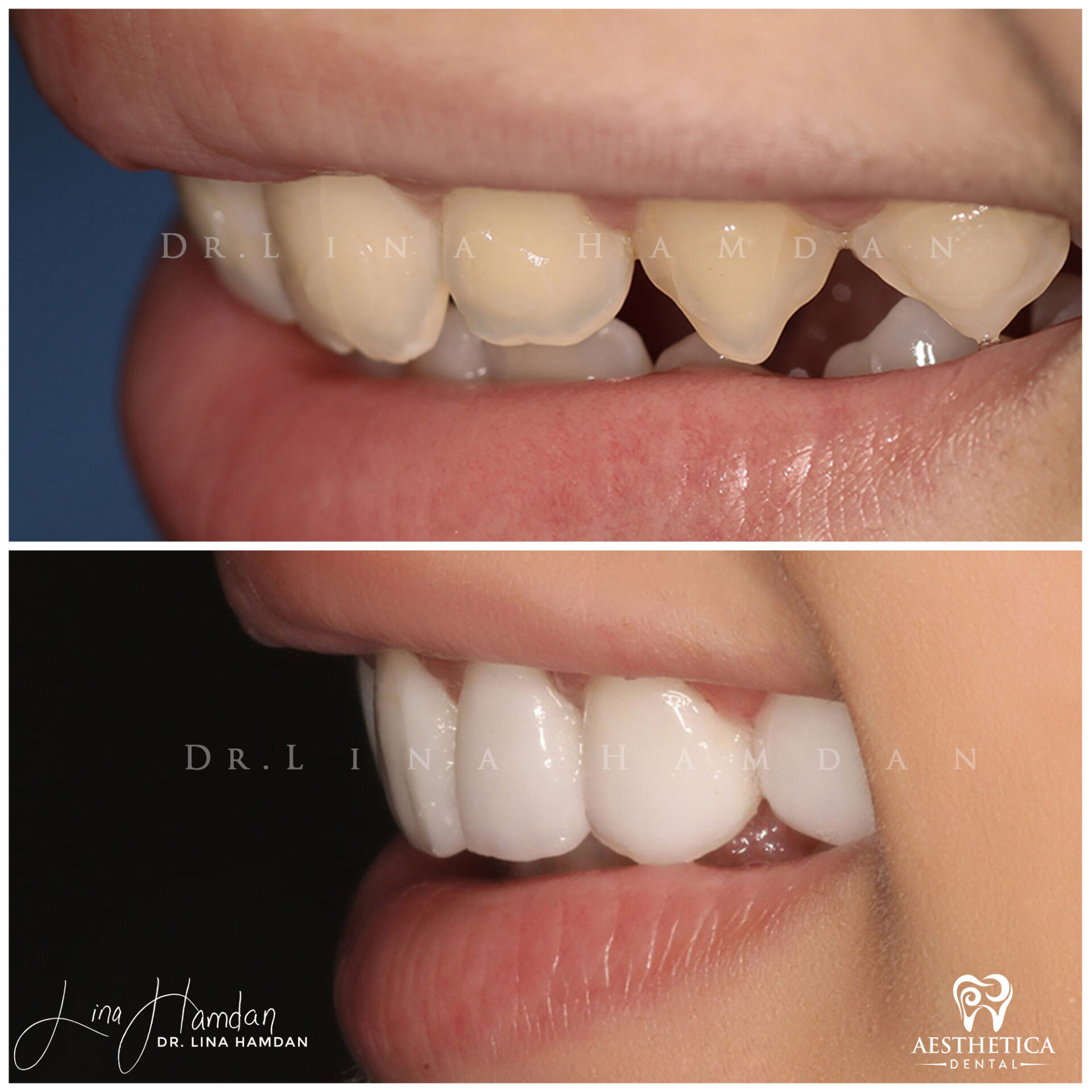 Porcelain Veneers case done by Dr. Lina Hamdan. - Before and After Images - 4